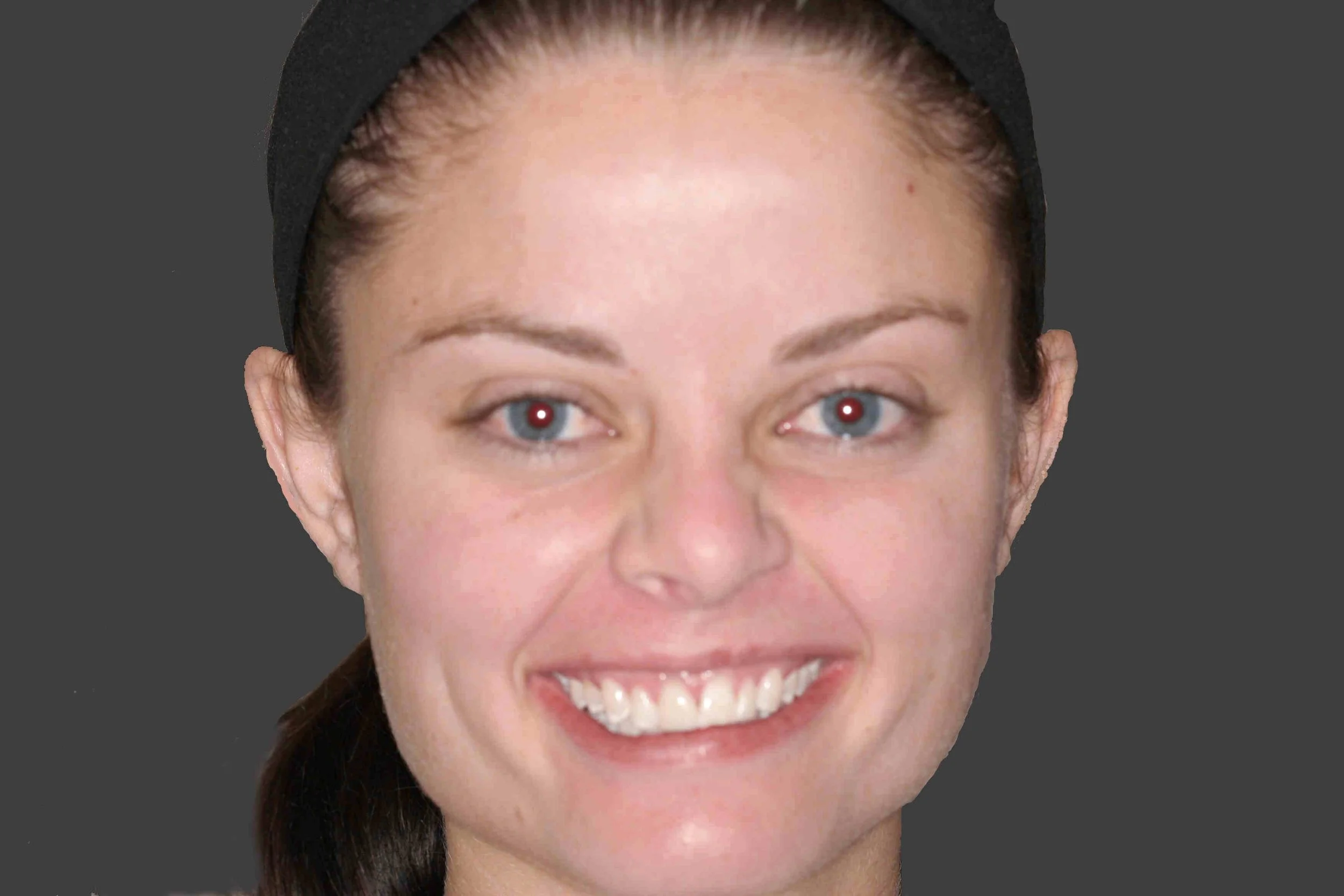 Before: photograph of the patient prior to esthetic crown lengthening.