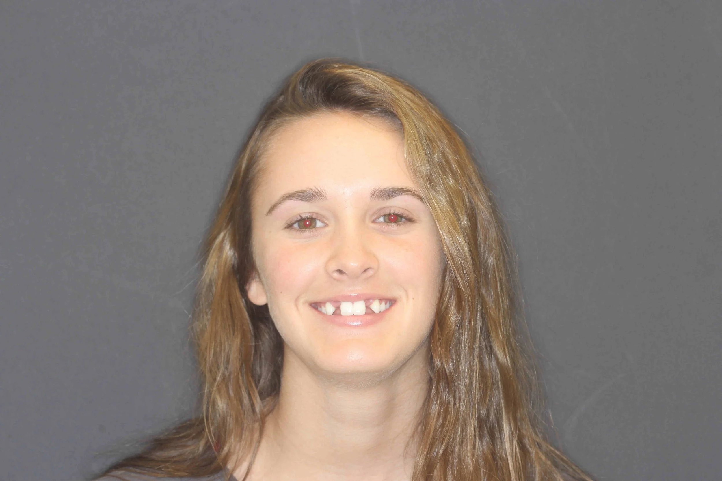 Before: a young patient smiling, upper front teeth undersized and uneven.