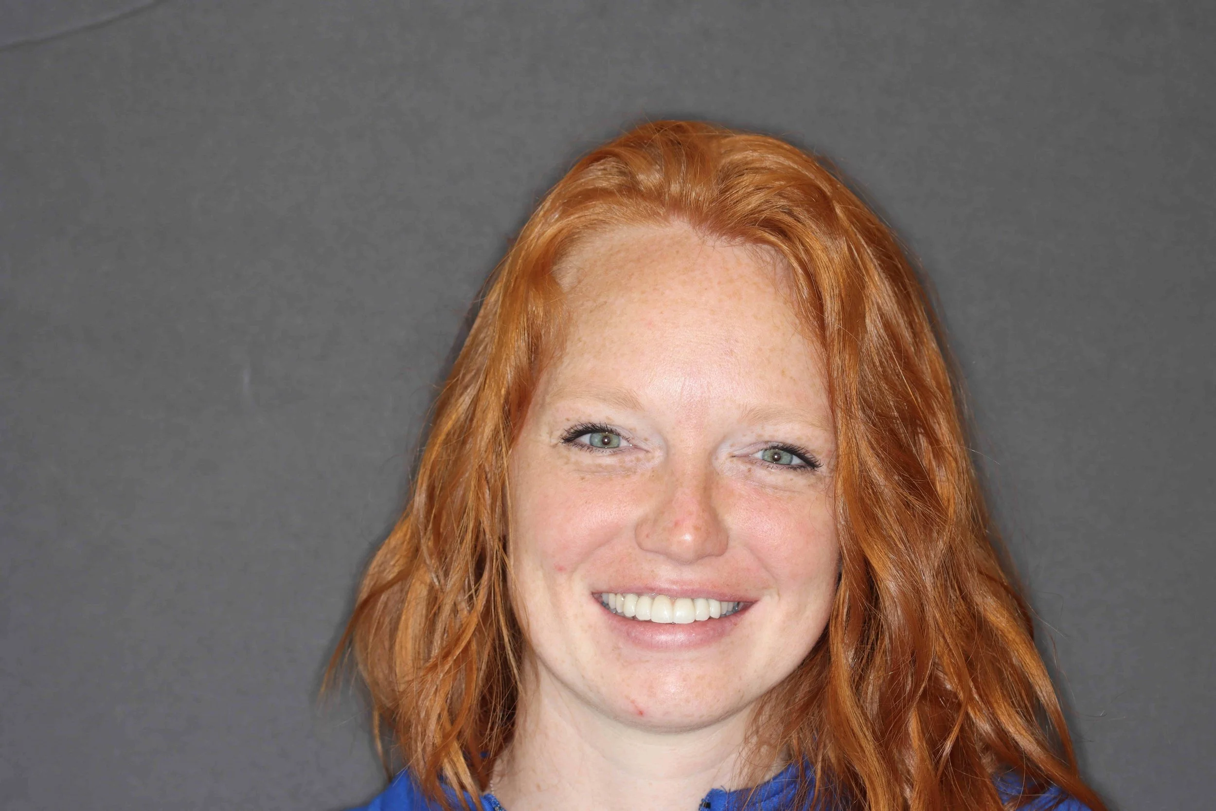 After: patient smiling with her upper front teeth restored on four dental implants.