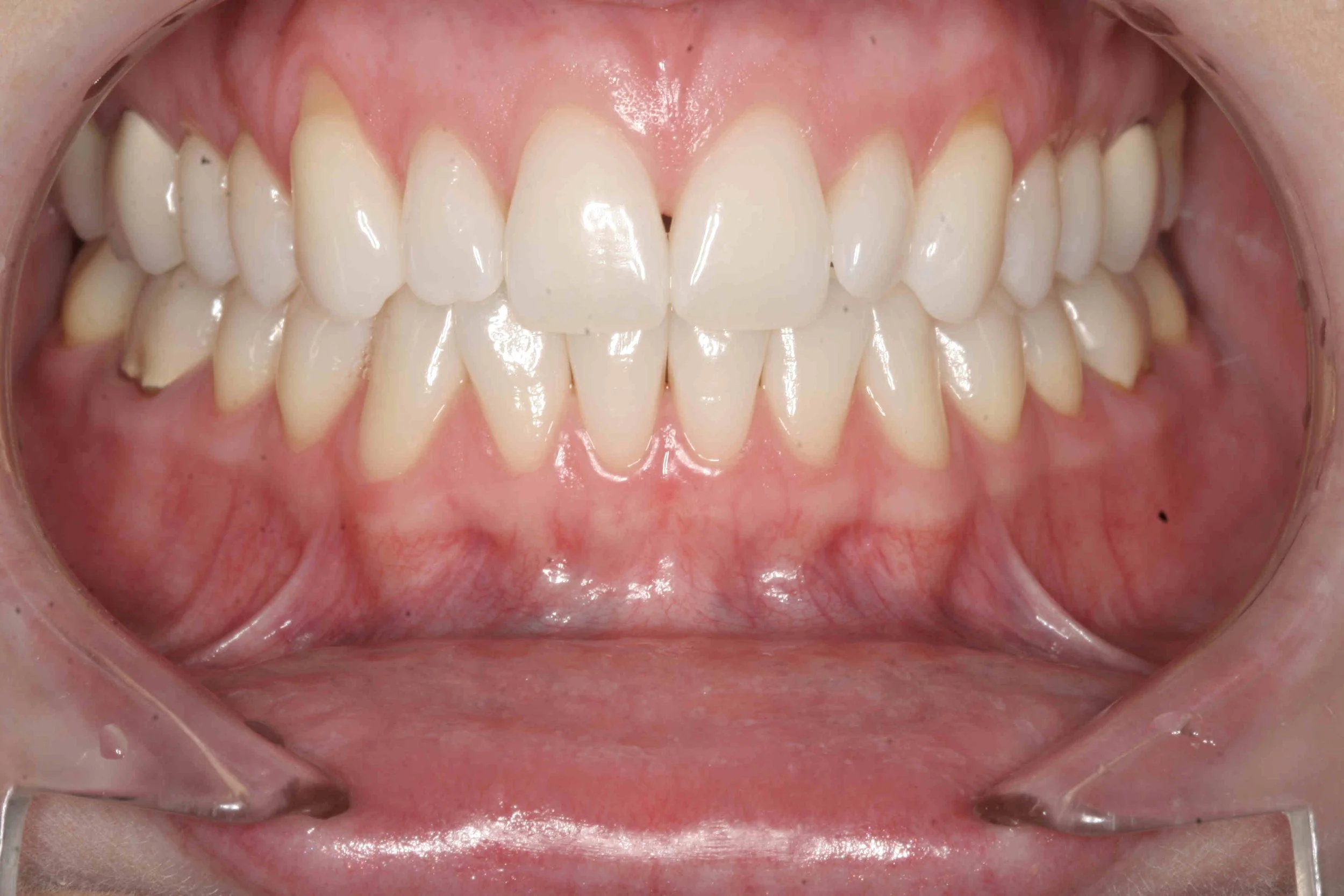 Before: retracted intraoral view showing recession on the upper canines.