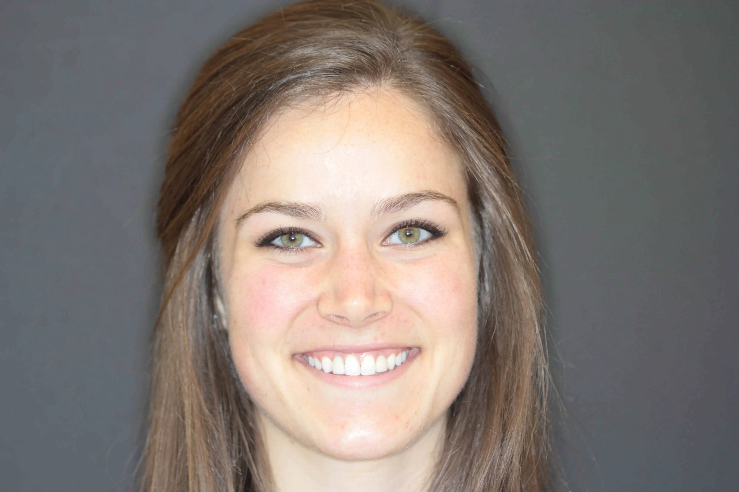 After: patient smiling with implant crowns filling both lateral incisor spaces.
