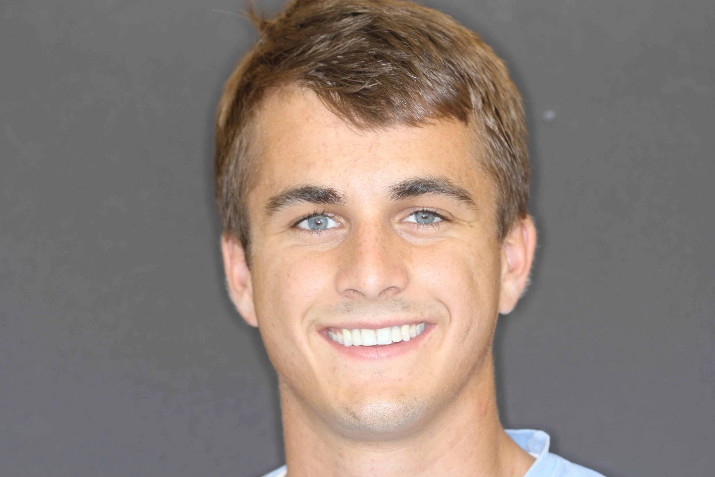 After: young male patient smiling with both upper lateral incisors restored on implants.