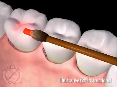 Video thumbnail: animation of LANAP laser treatment.