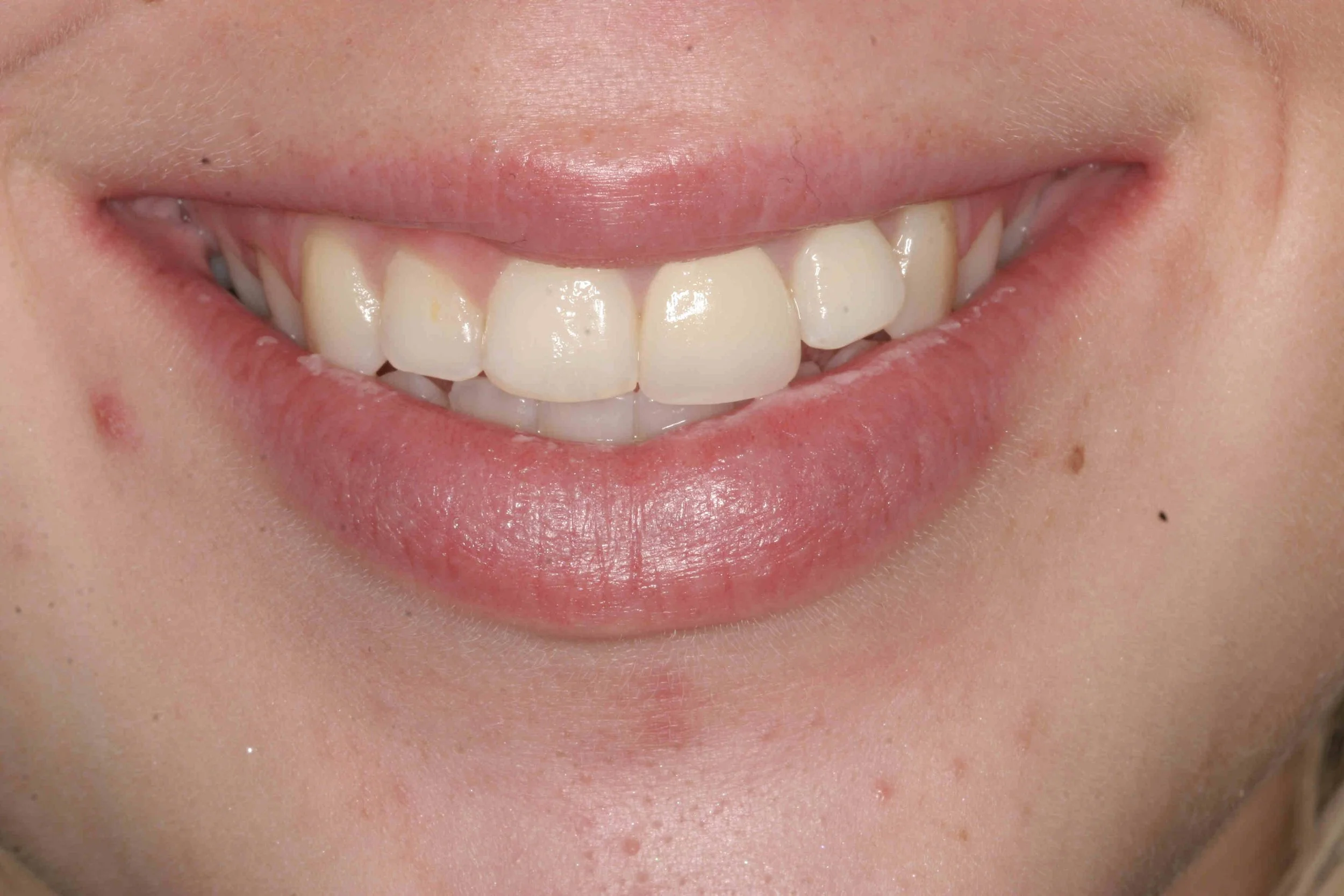 Before: close-up of the patient's smile showing an unbalanced gum line and a discoloured crowned front tooth.
