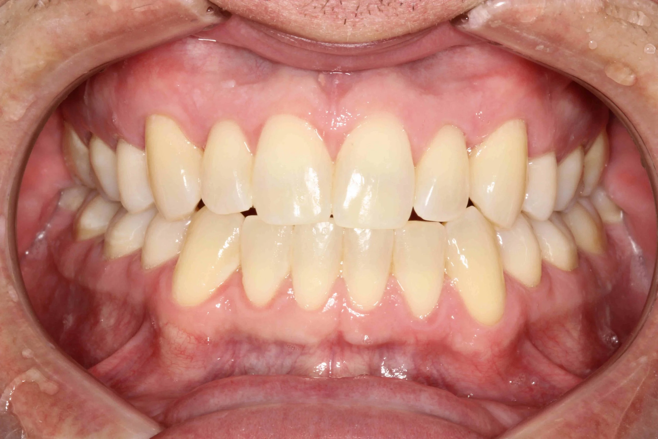 After: full root coverage achieved on the upper canines.