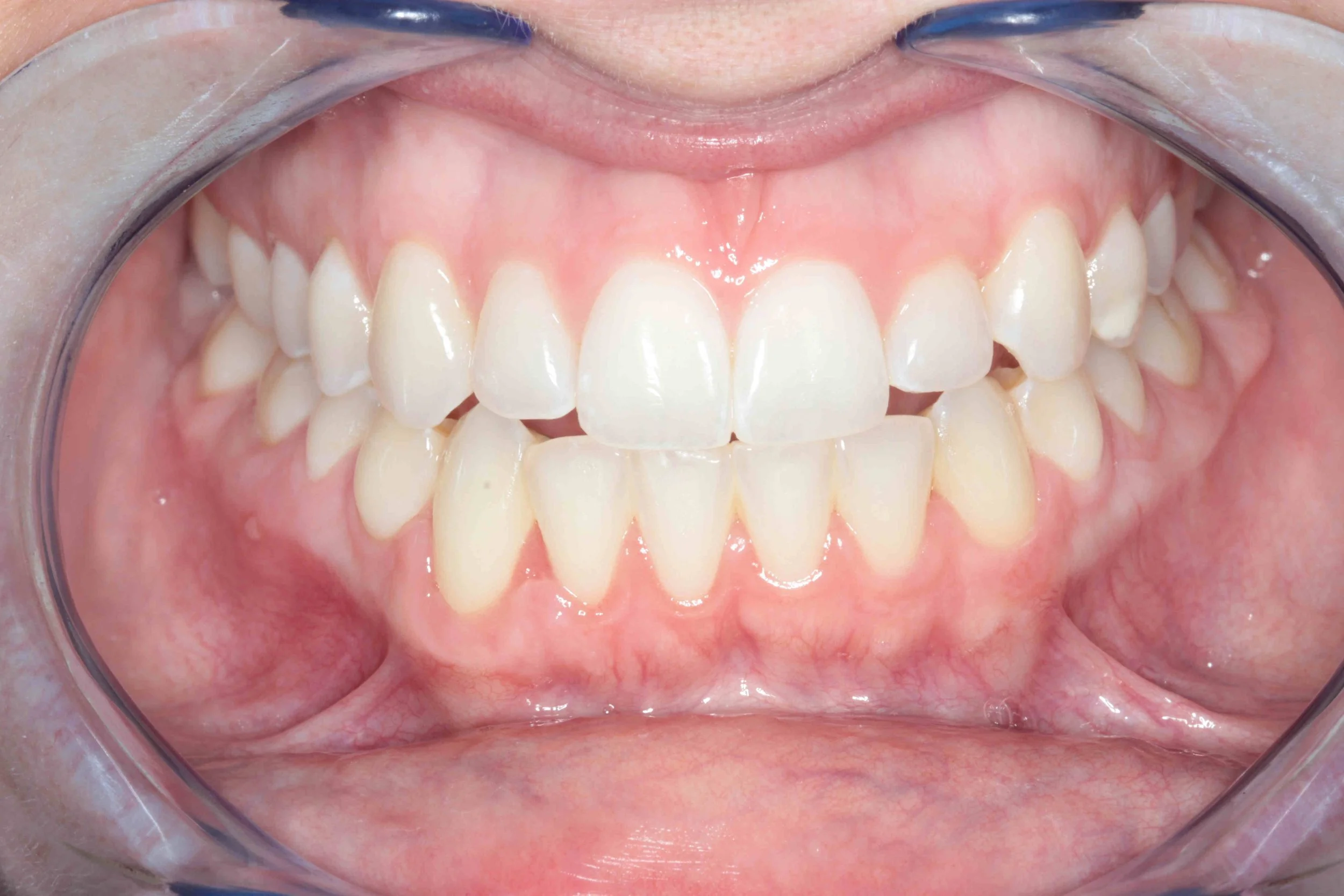 After: advanced recession on the lower right canine corrected with connective tissue grafting.