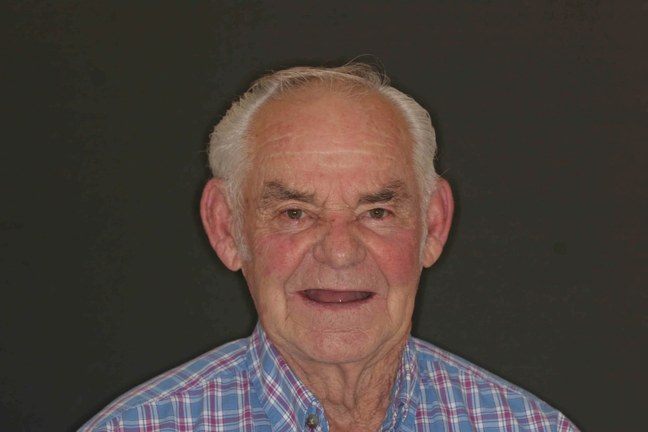 Before: an older adult patient photographed straight on without his removable partial denture, upper front teeth missing and his lips drawn in over the gap.