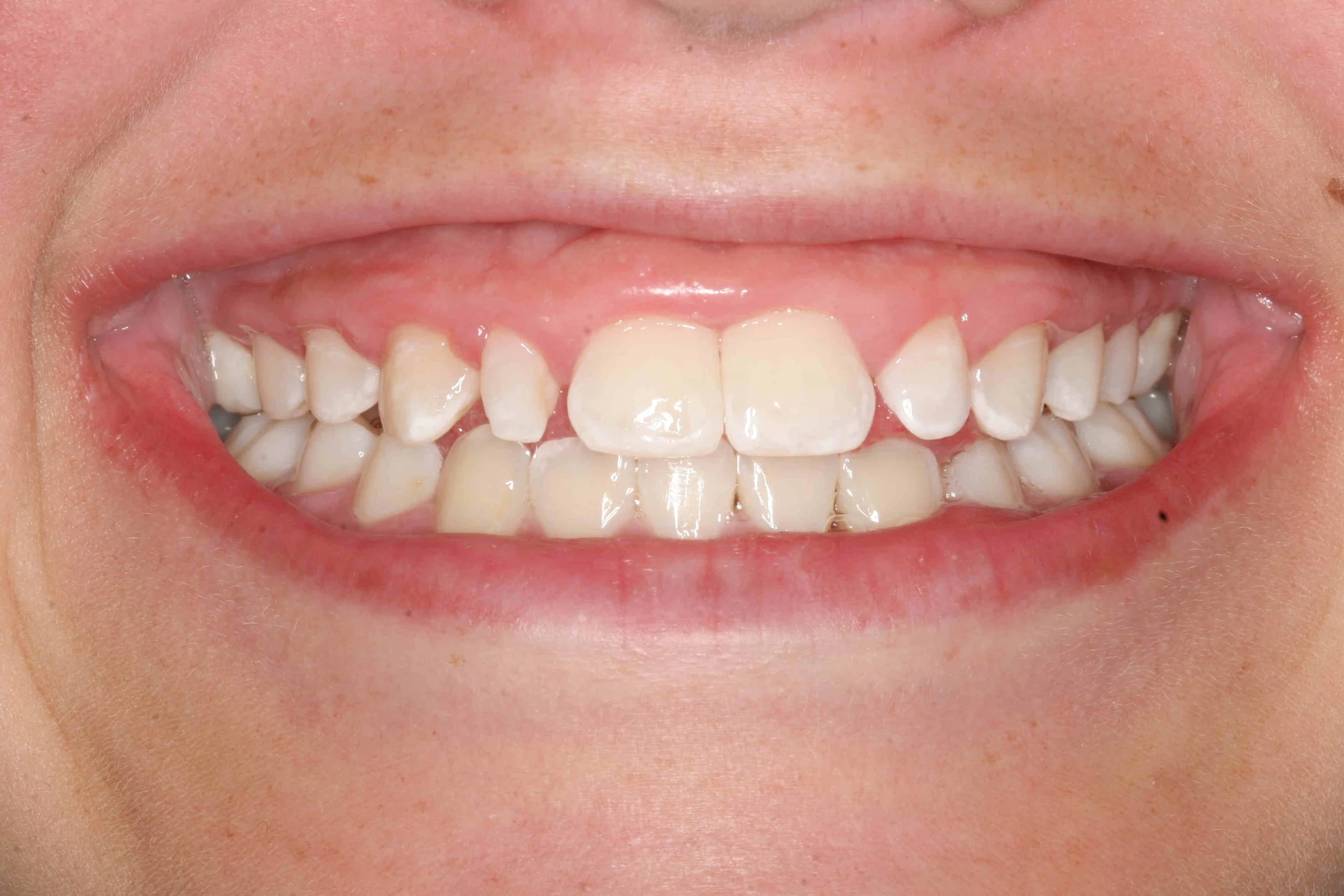 Before: close-up of the patient's smile showing a broad band of gum tissue above short-looking teeth.