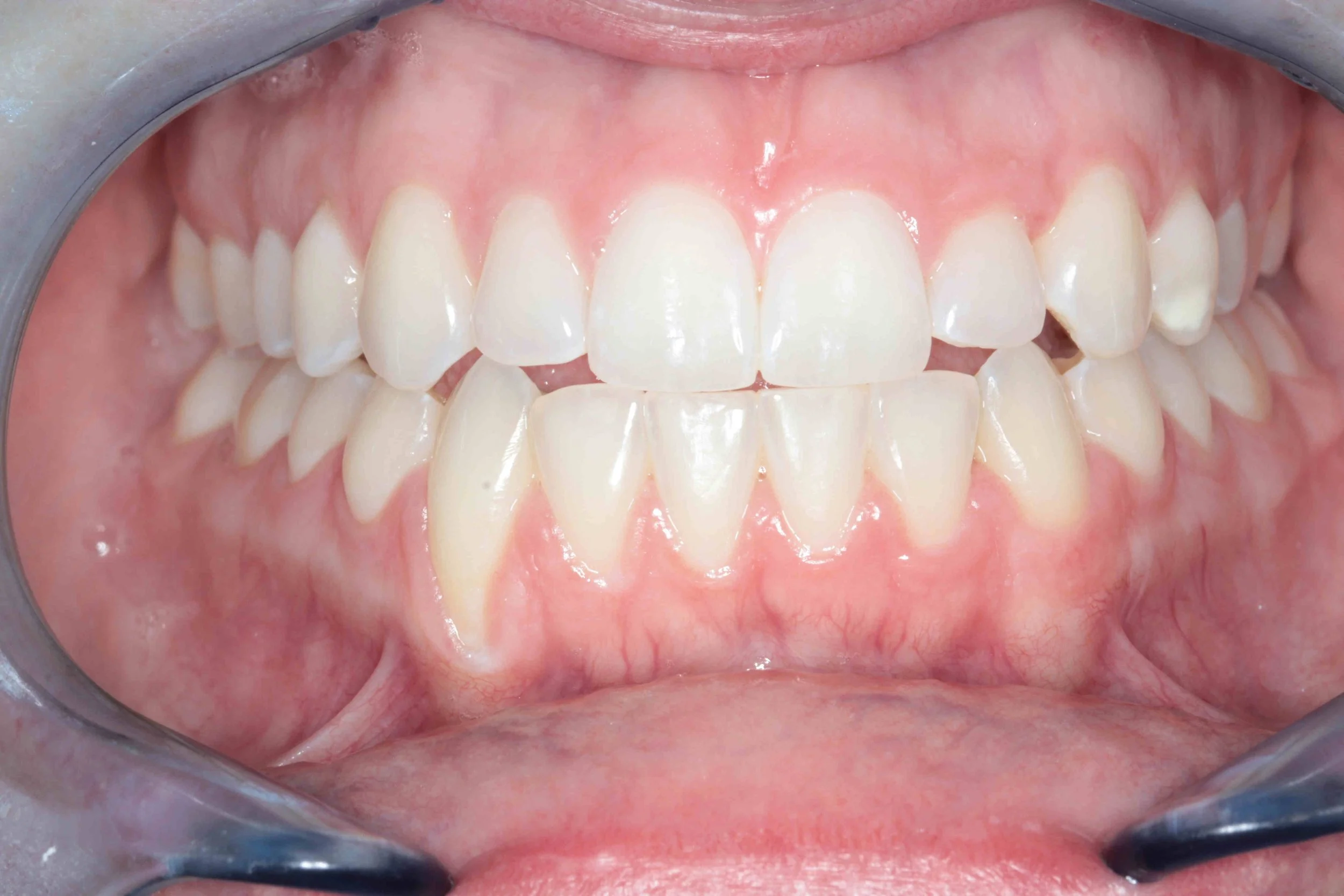 Before: retracted intraoral view showing advanced recession on the lower right canine.