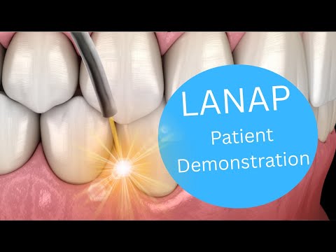 Video thumbnail: Dr. Alex Bankhead explaining LANAP laser gum treatment.