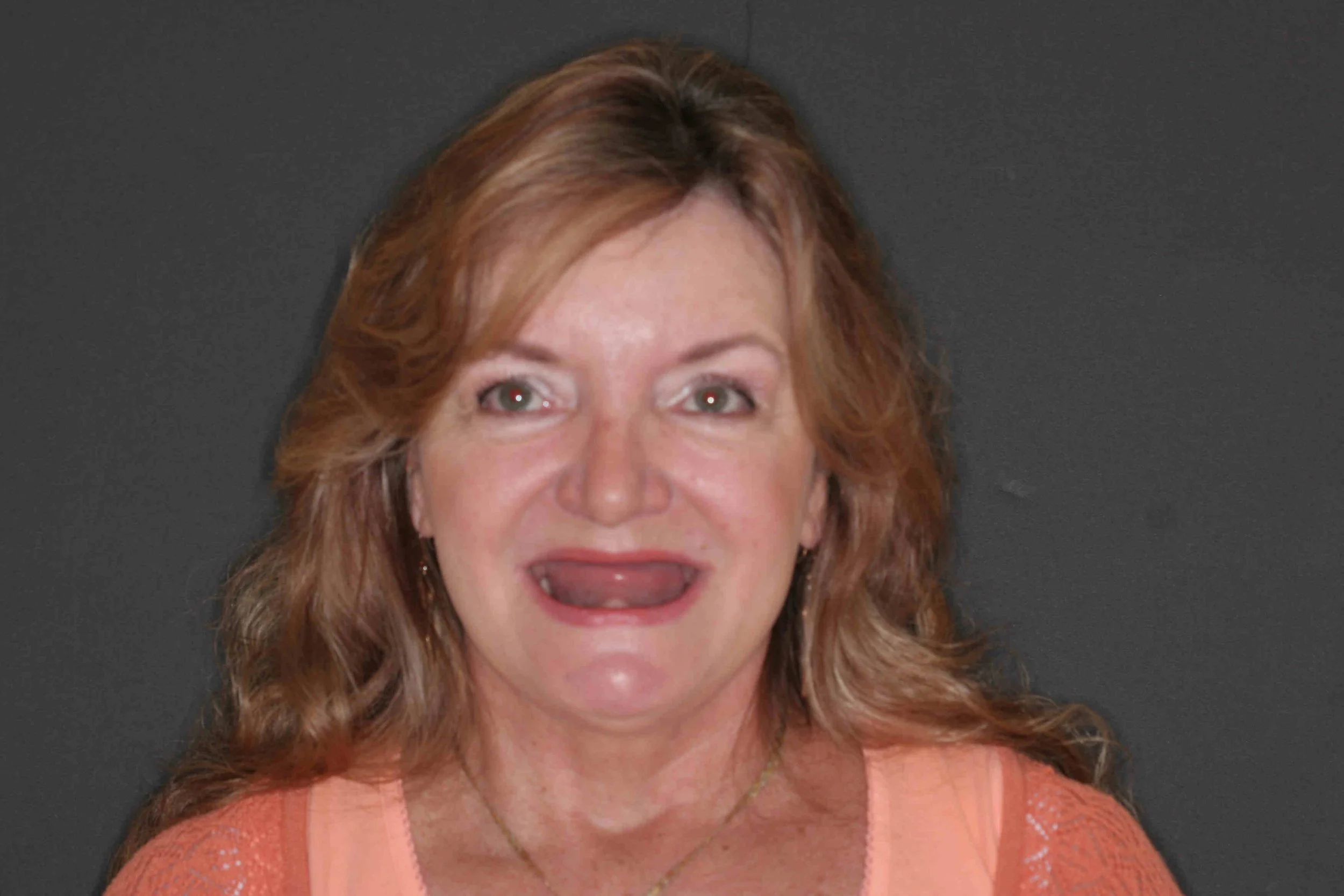 Before: a 59-year-old patient photographed with her lips drawn over her conventional upper denture.