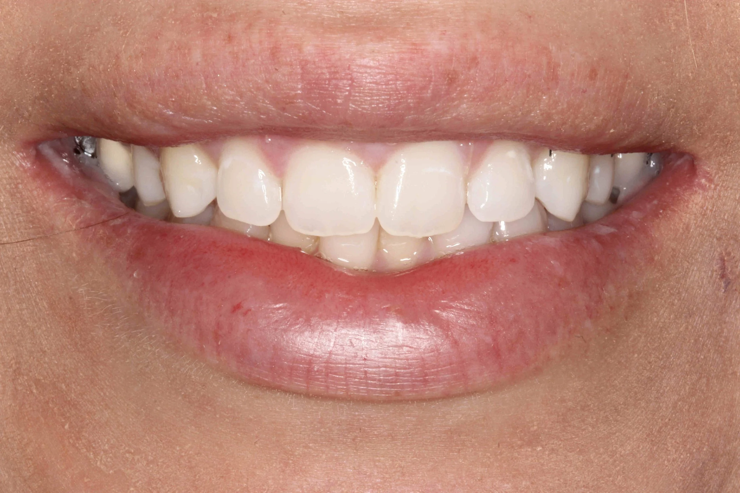 After: one week following lip repositioning, showing less gum tissue when smiling.