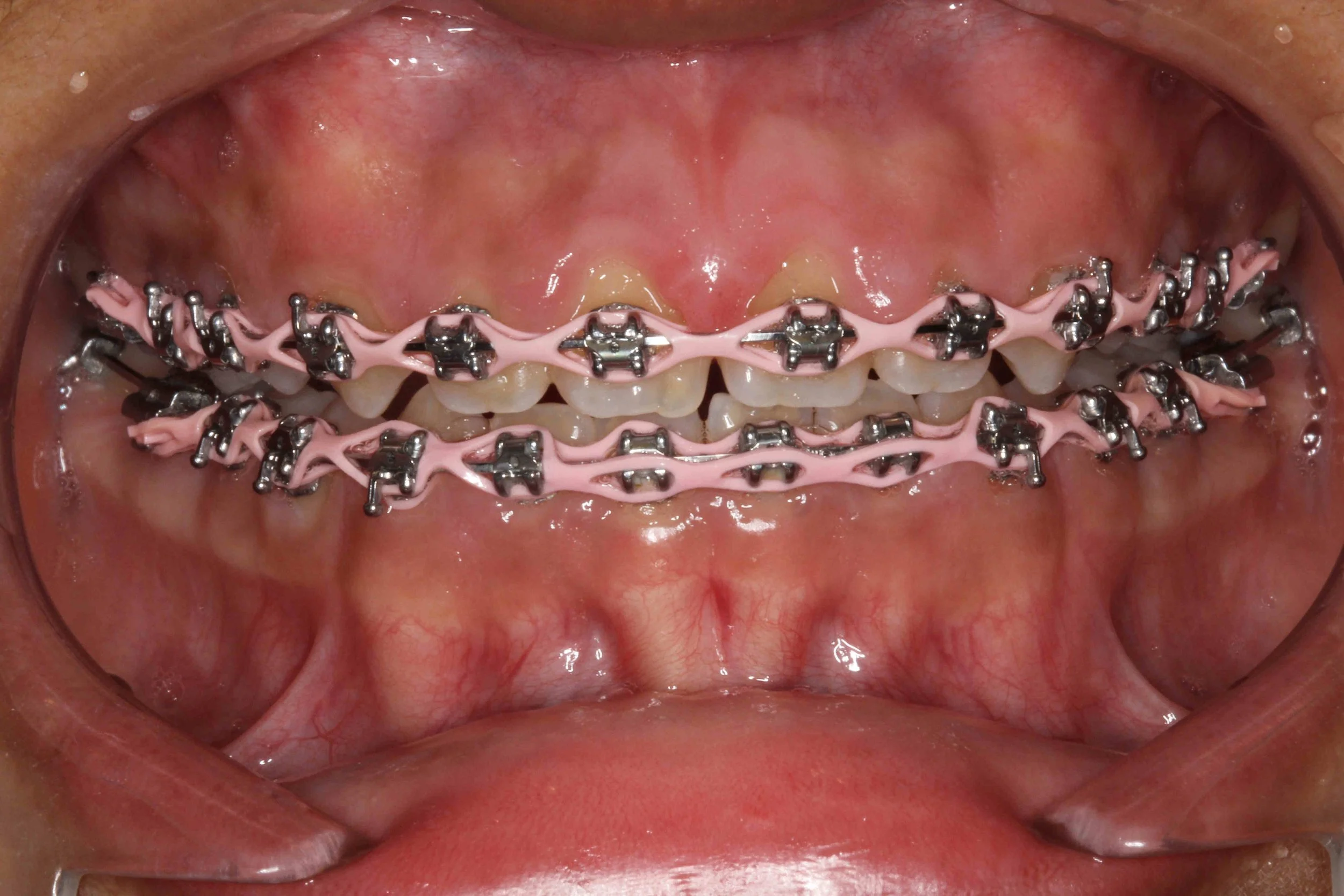 Before: clinical photograph showing gum tissue overgrown around orthodontic appliances.