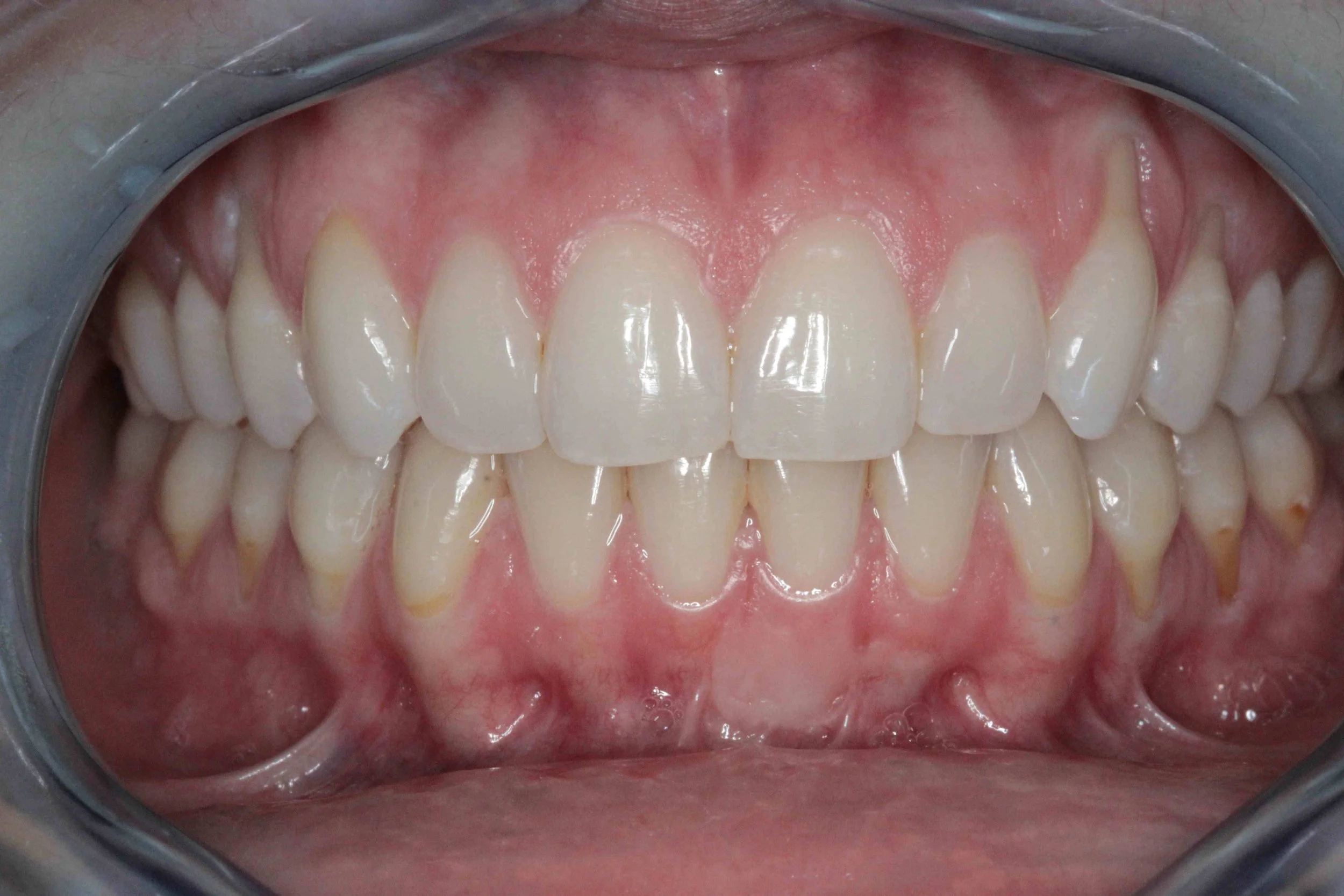 Before: retracted intraoral view showing gum recession and exposed root surfaces on the left side.