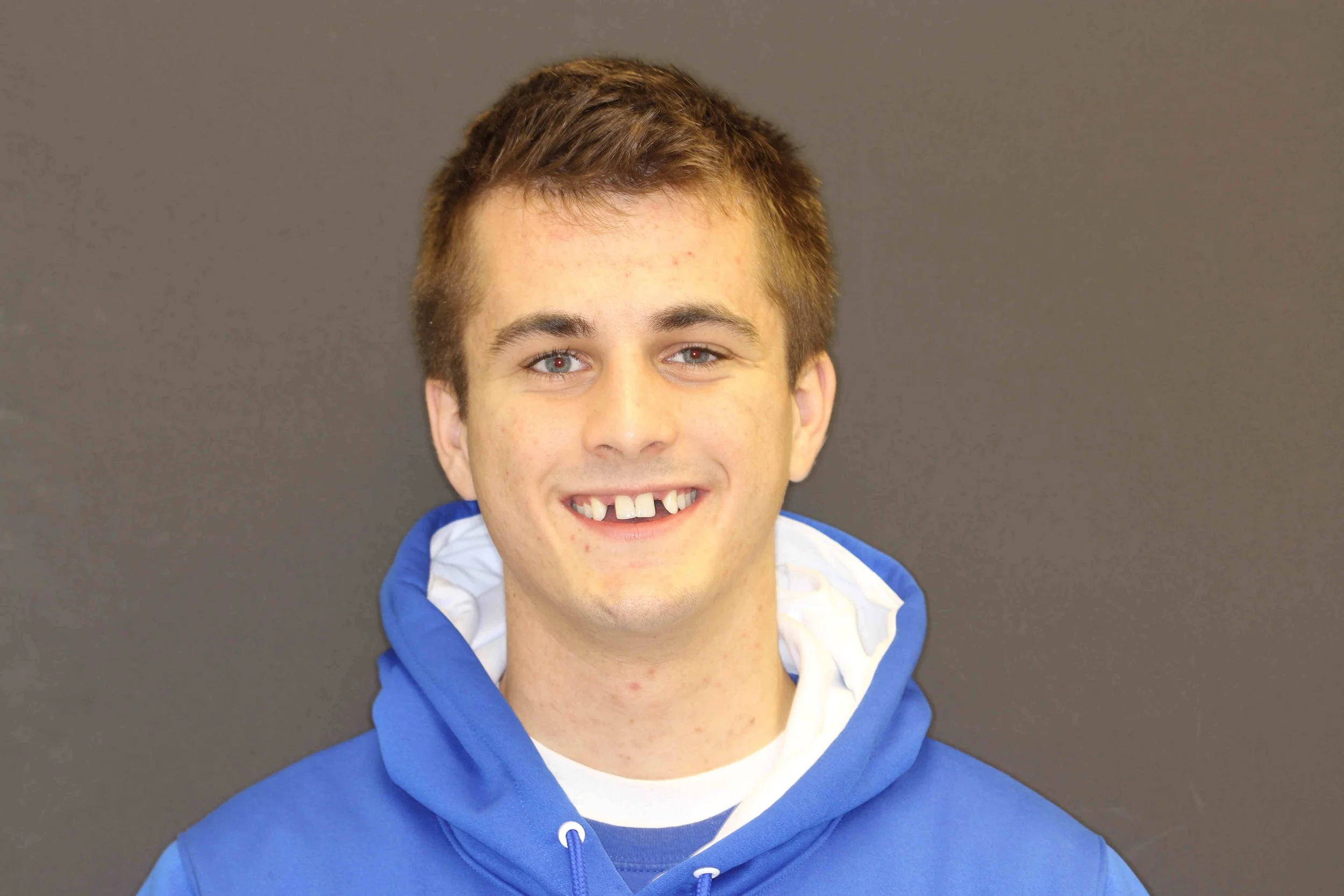 Before: a 21-year-old male patient smiling with both upper lateral incisors missing.