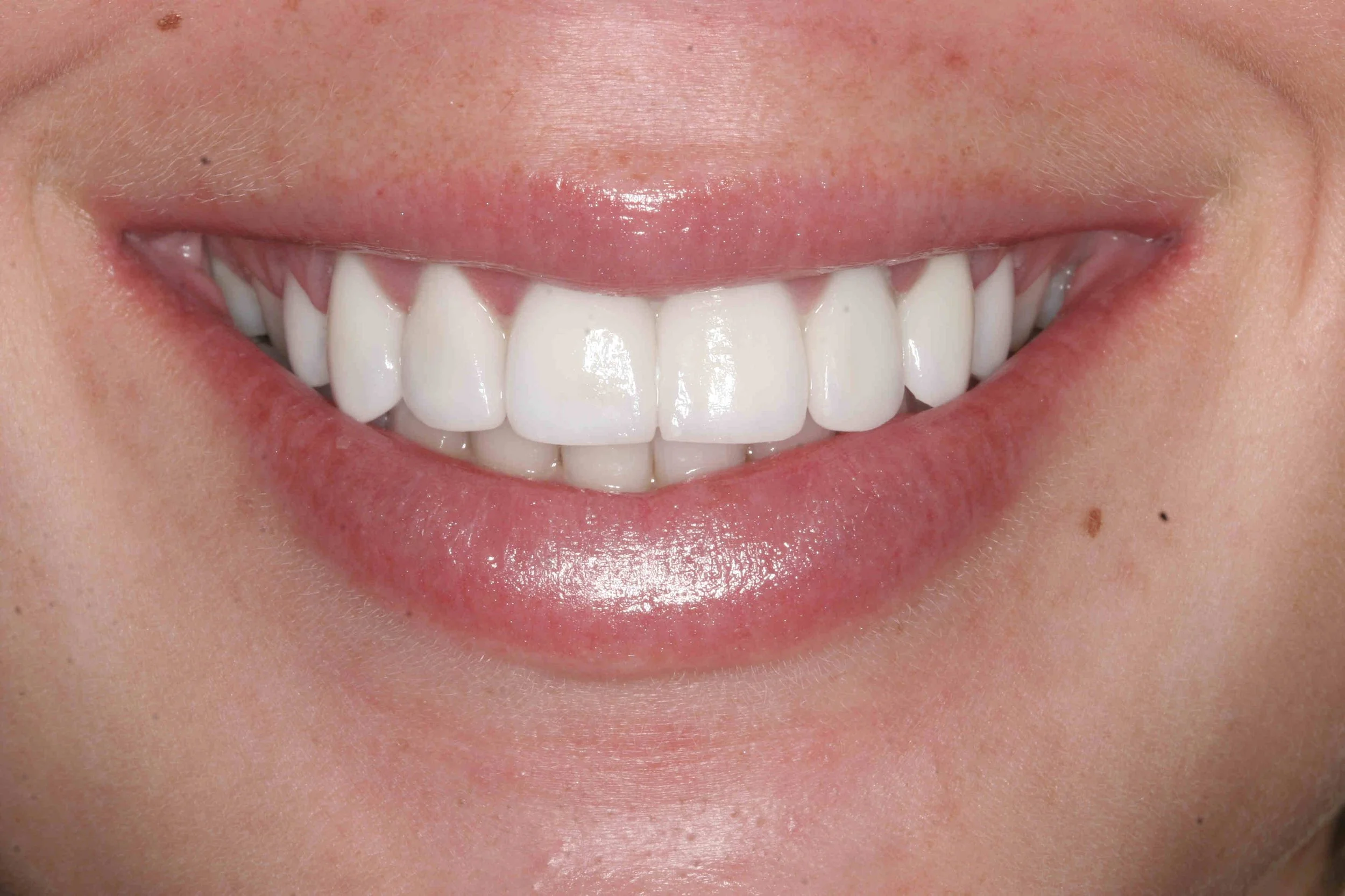 After: hard tissue crown lengthening on the right side, matched to the left, ready for veneers.