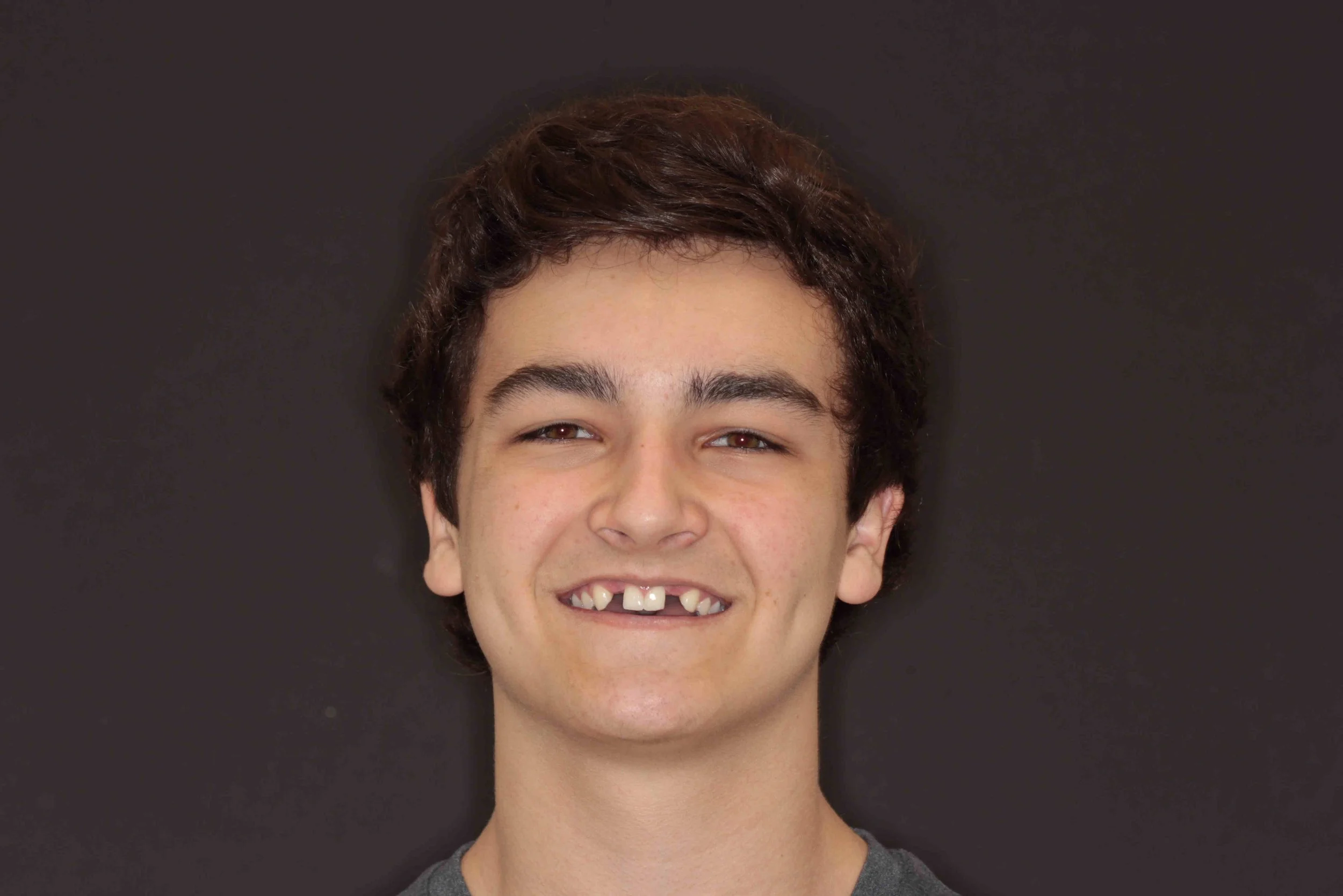 Before: a teenage patient smiling with both upper lateral incisors missing after orthodontic treatment.