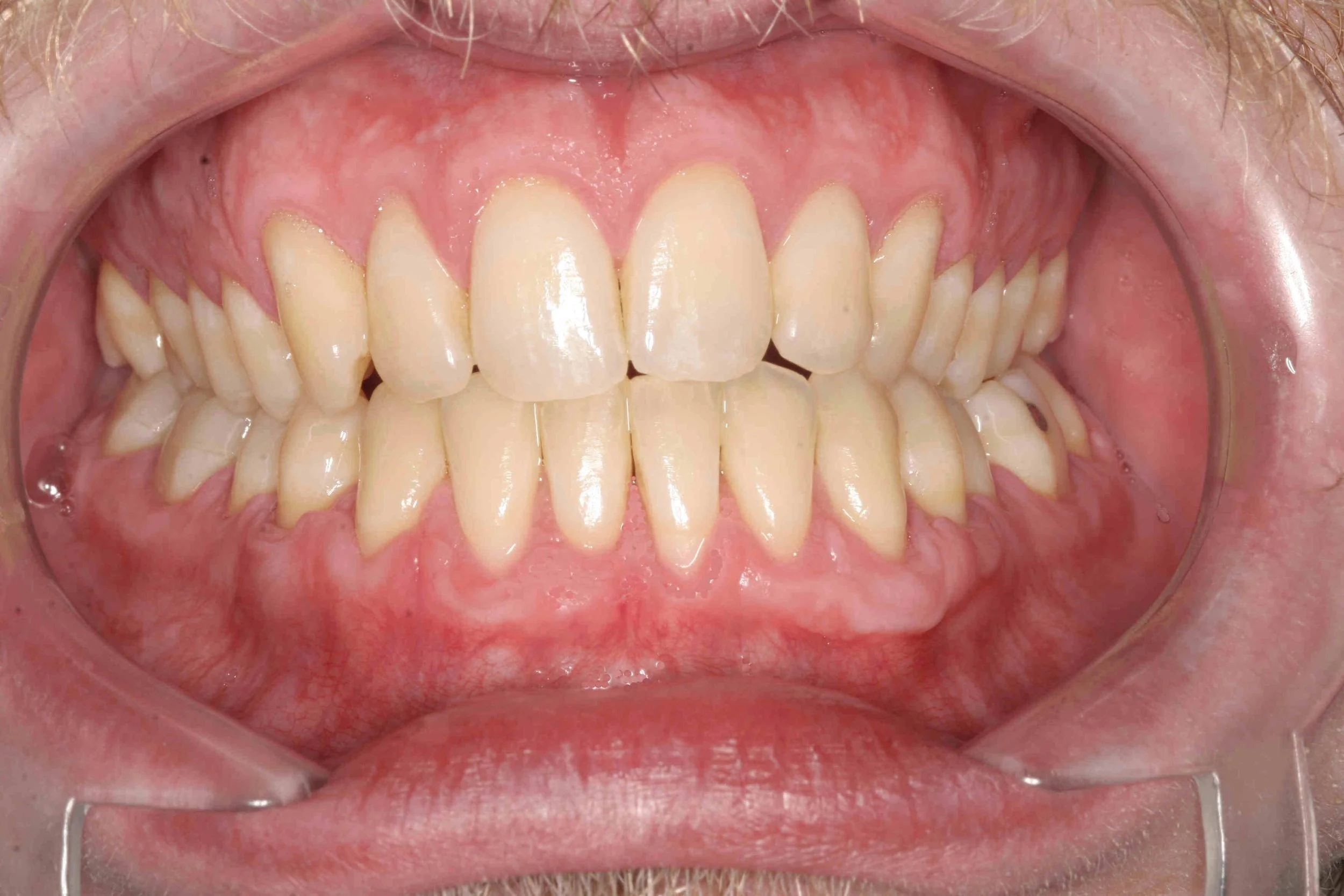 After: gum tissue rebuilt with connective tissue grafting following aggressive brushing.