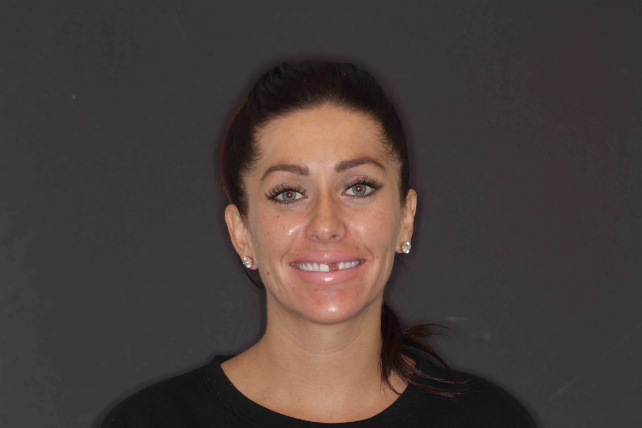 Before: a 29-year-old patient smiling with a broken-off upper front tooth.