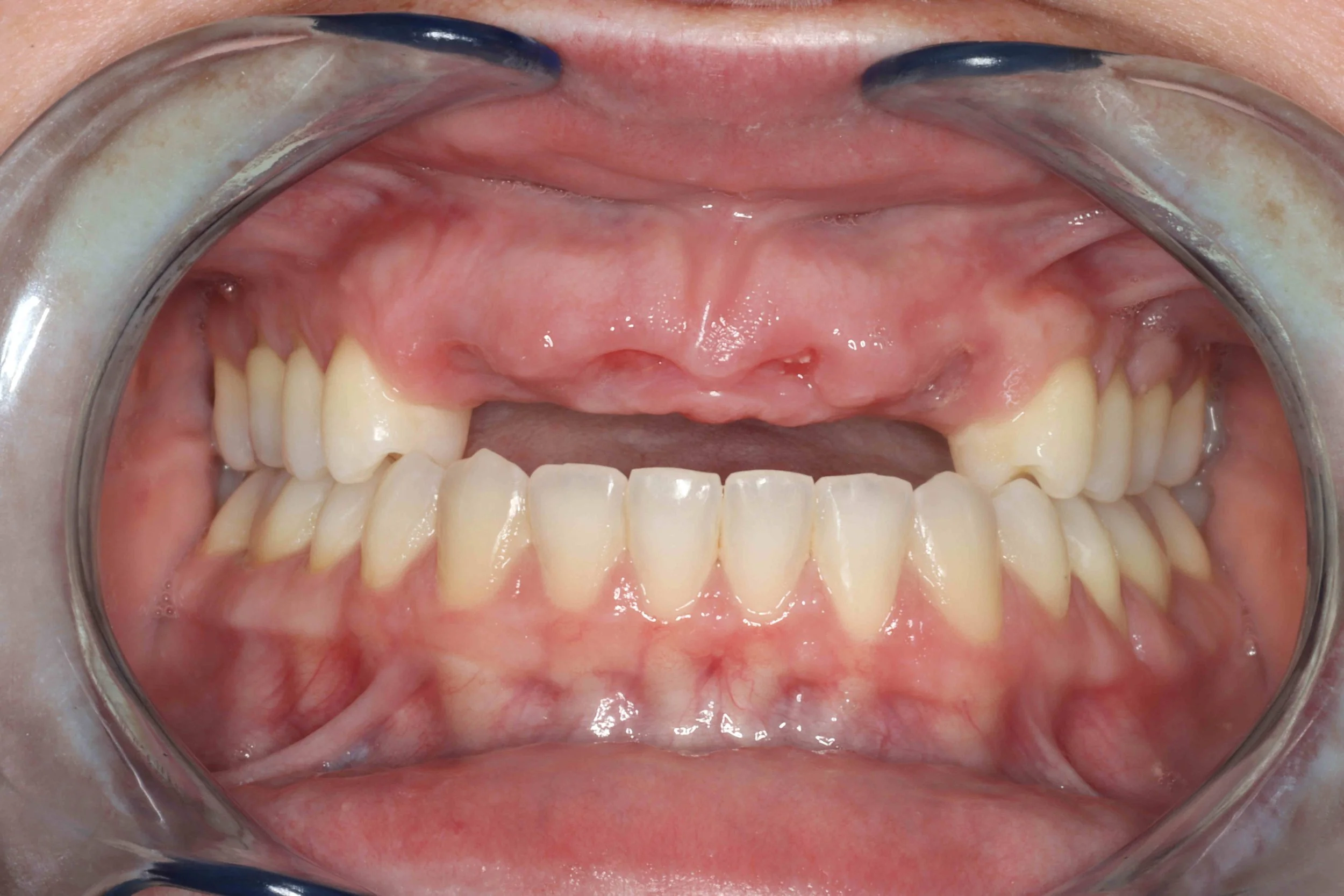 Before: retracted intraoral view of the patient's upper and lower front teeth prior to implant treatment.
