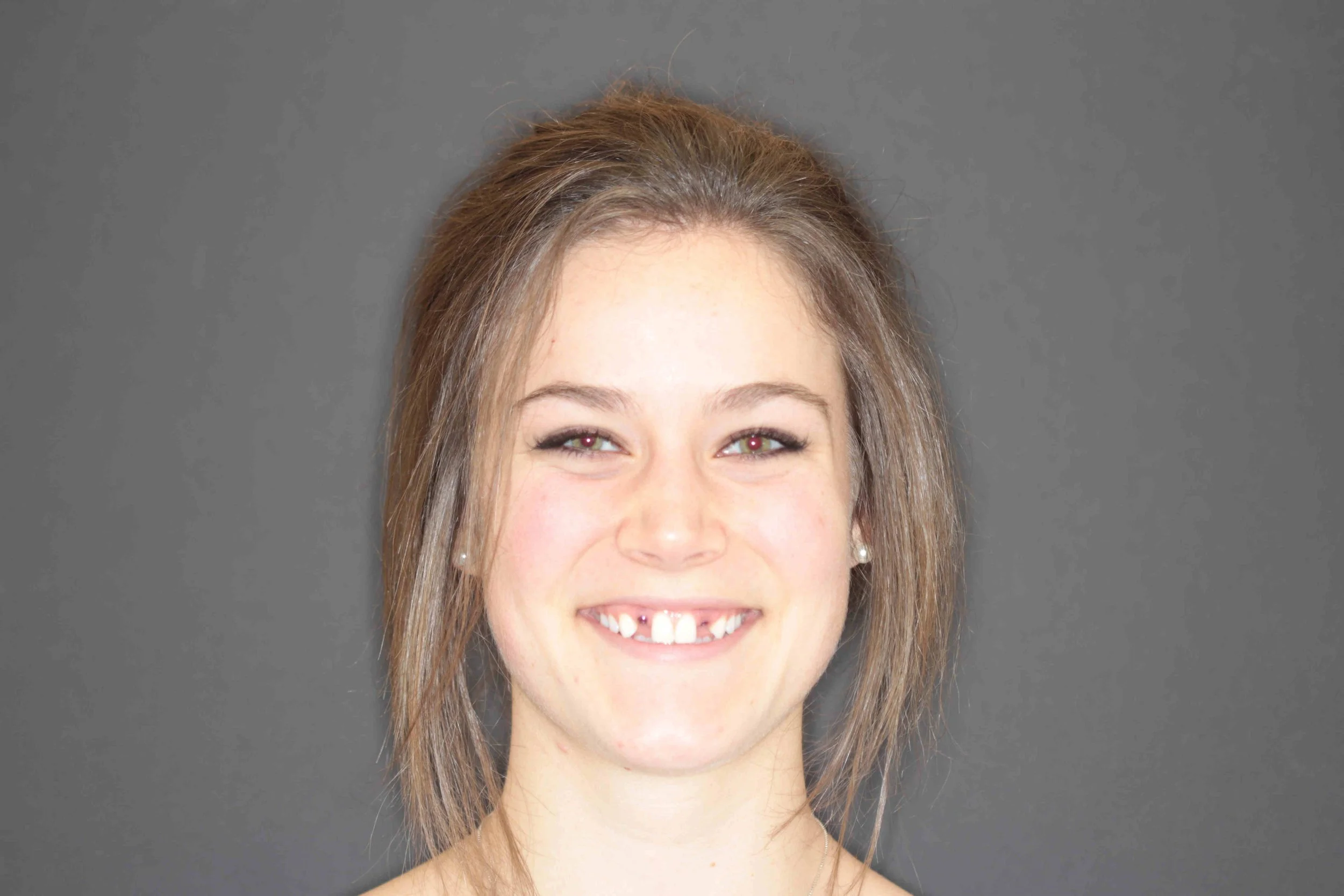 Before: an 18-year-old patient smiling with gaps where her upper lateral incisors are missing.
