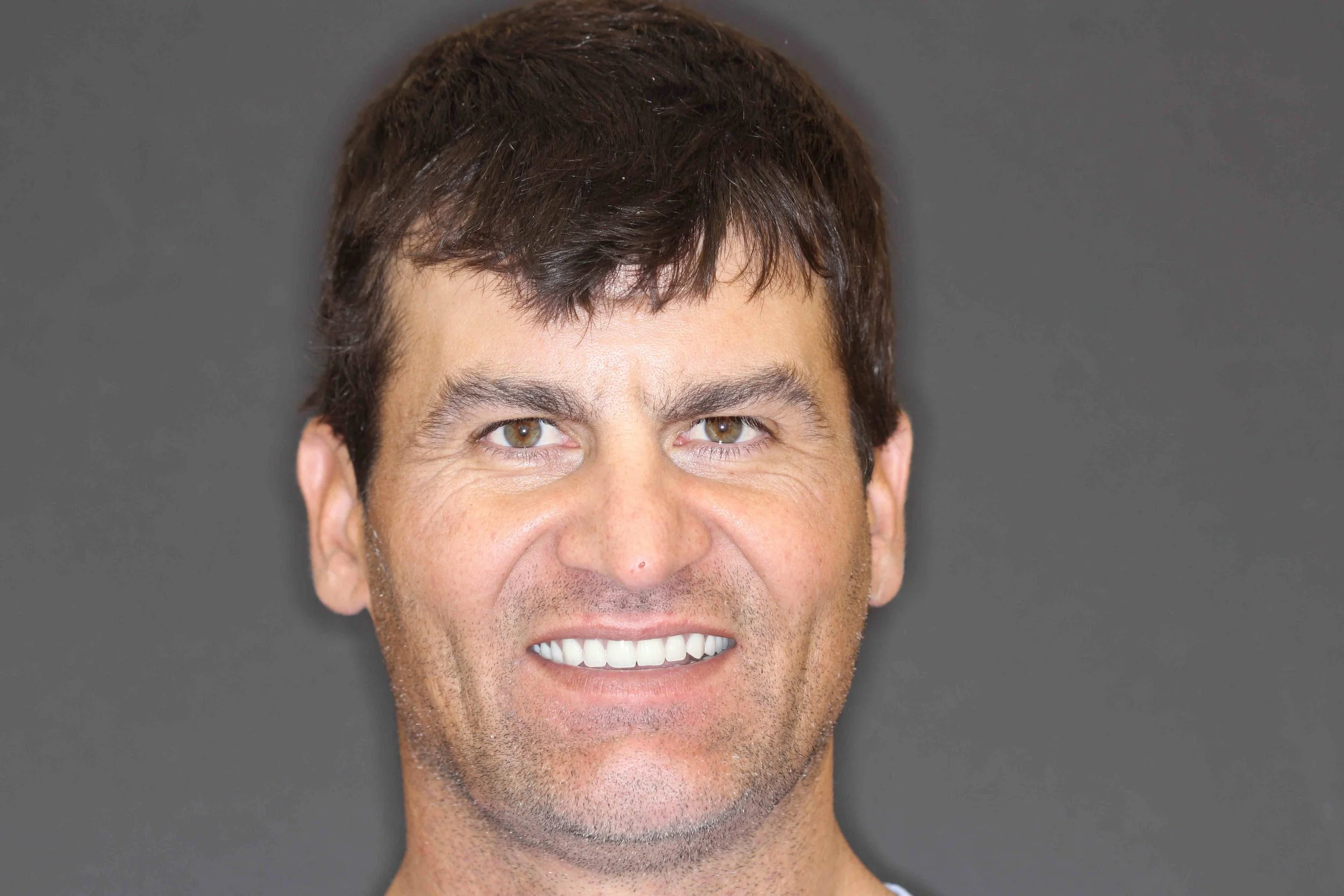 After: patient smiling with both arches restored on implant-supported overdentures.