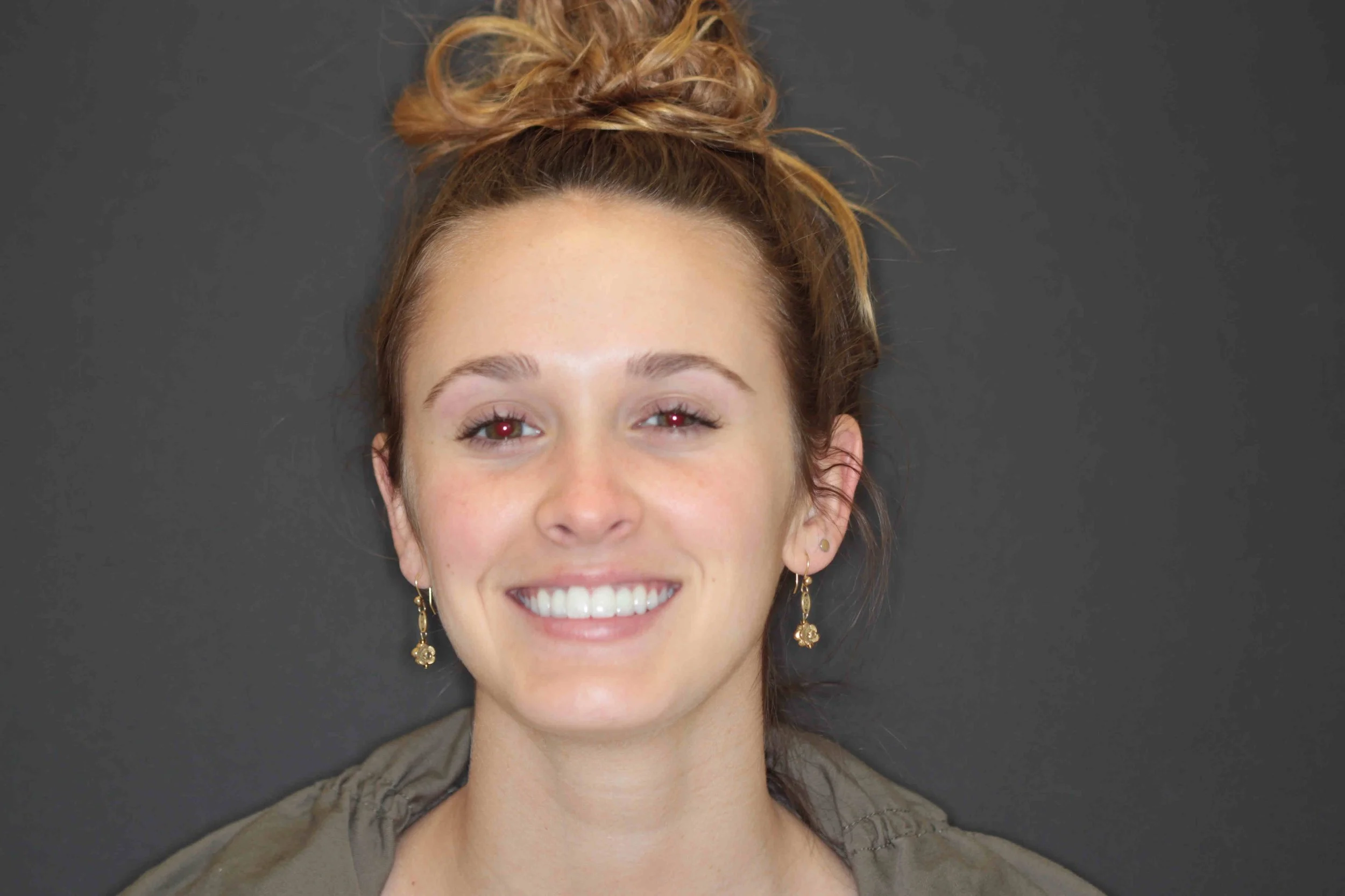 After: patient smiling with even, natural-looking upper front teeth.