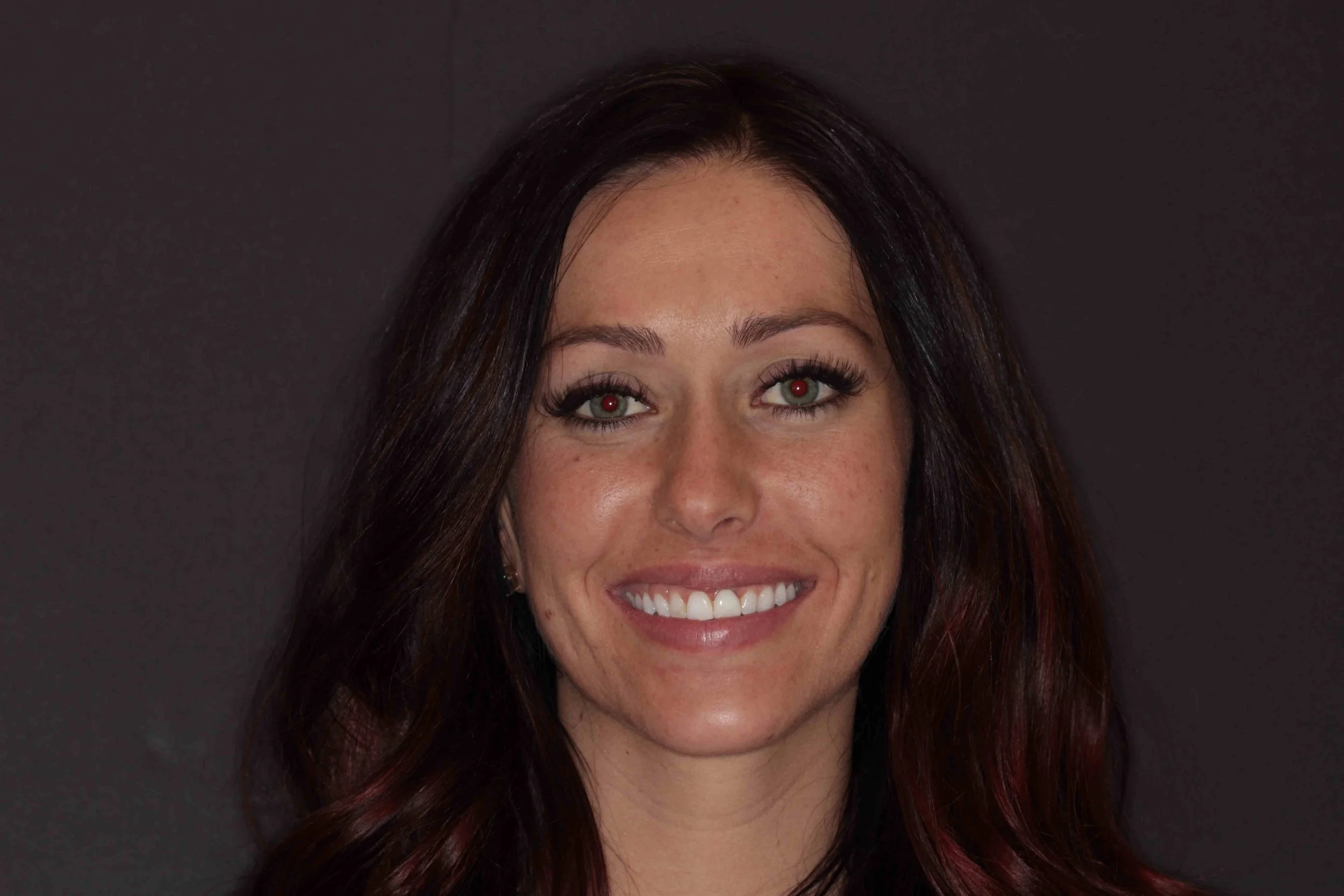 After: patient smiling, her broken front tooth replaced with an implant crown.