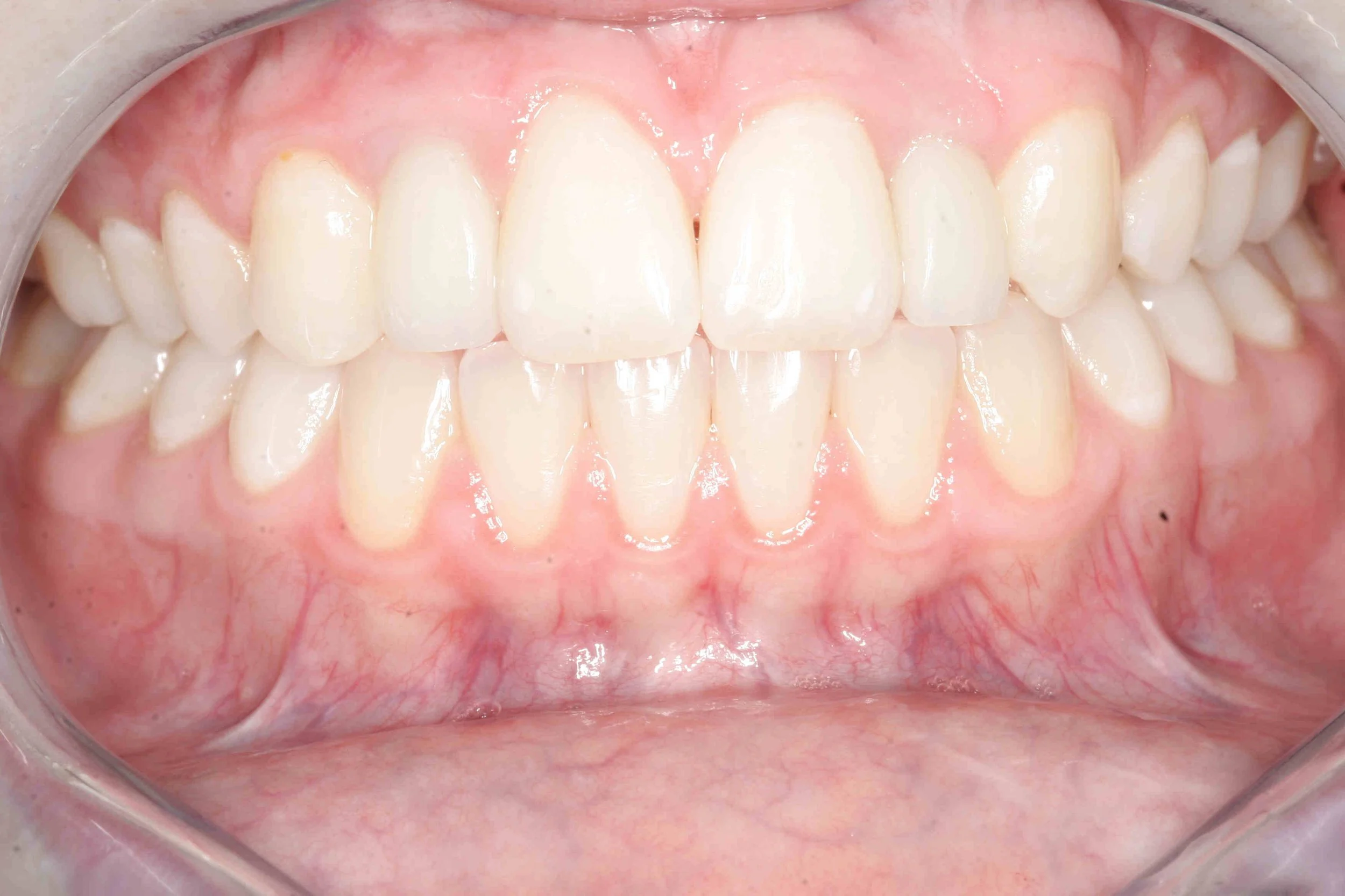 After: retracted intraoral view showing a replaced implant with healthy, even gum tissue.