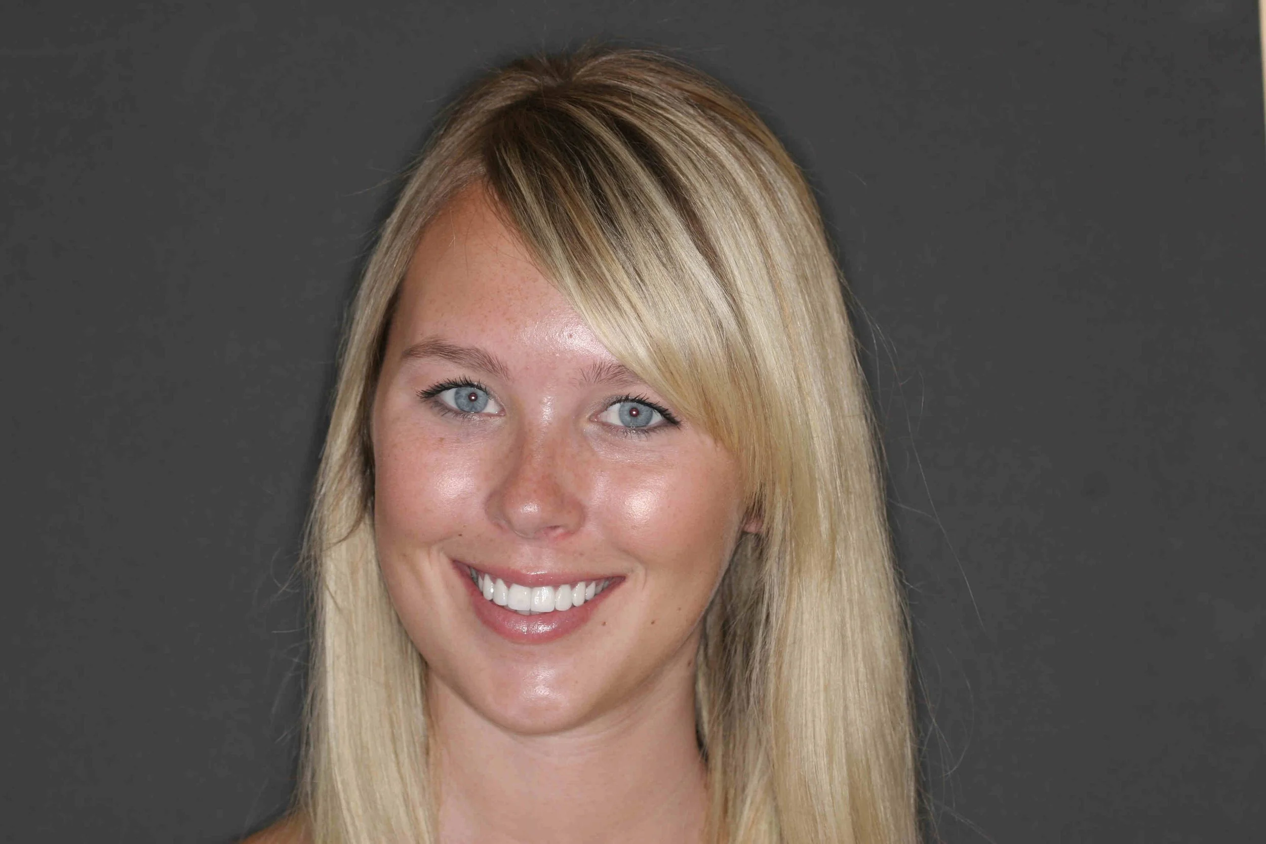 After: portrait of the same patient smiling following crown lengthening and veneers.
