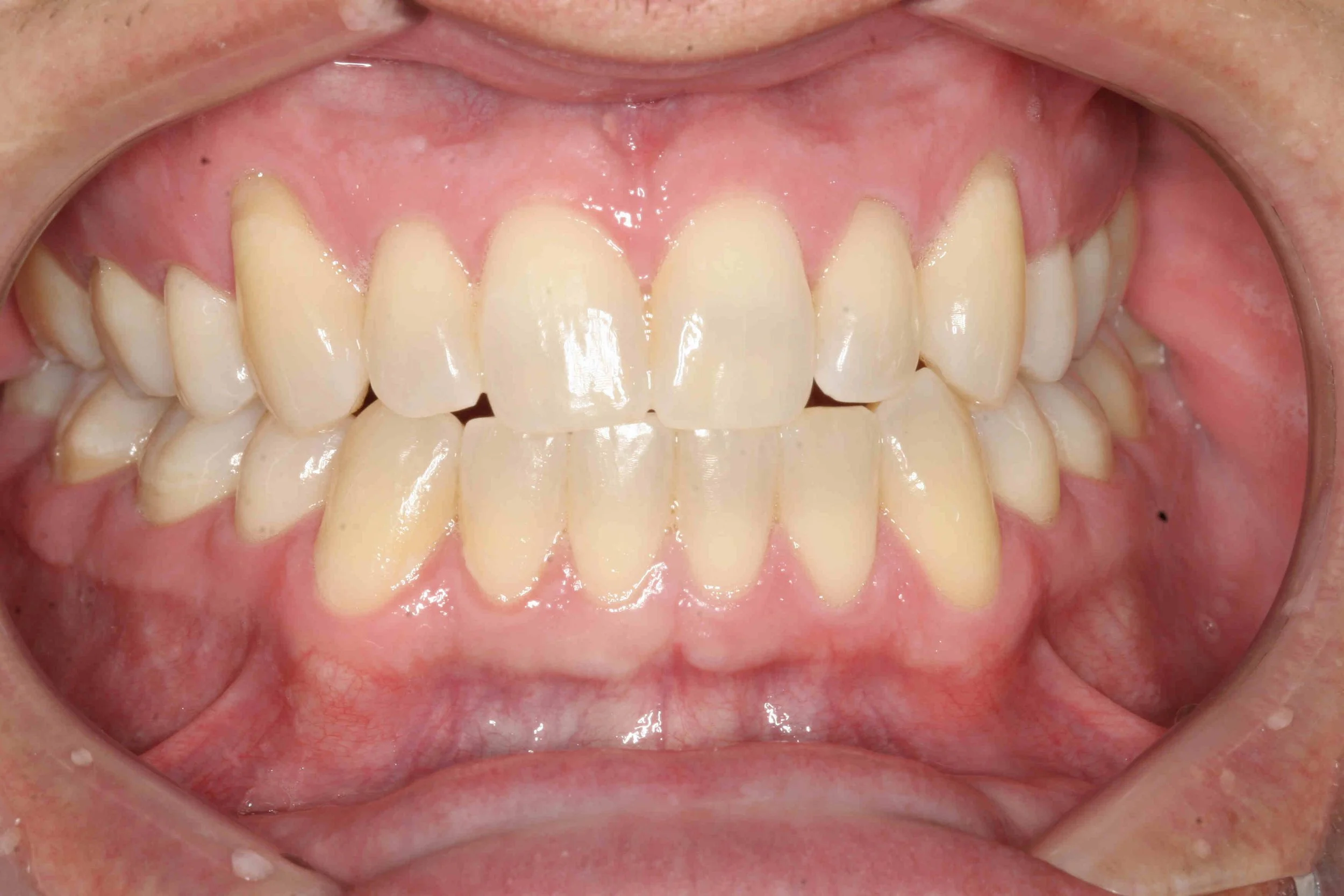 Before: retracted intraoral view showing recession and exposed roots on both upper canines.