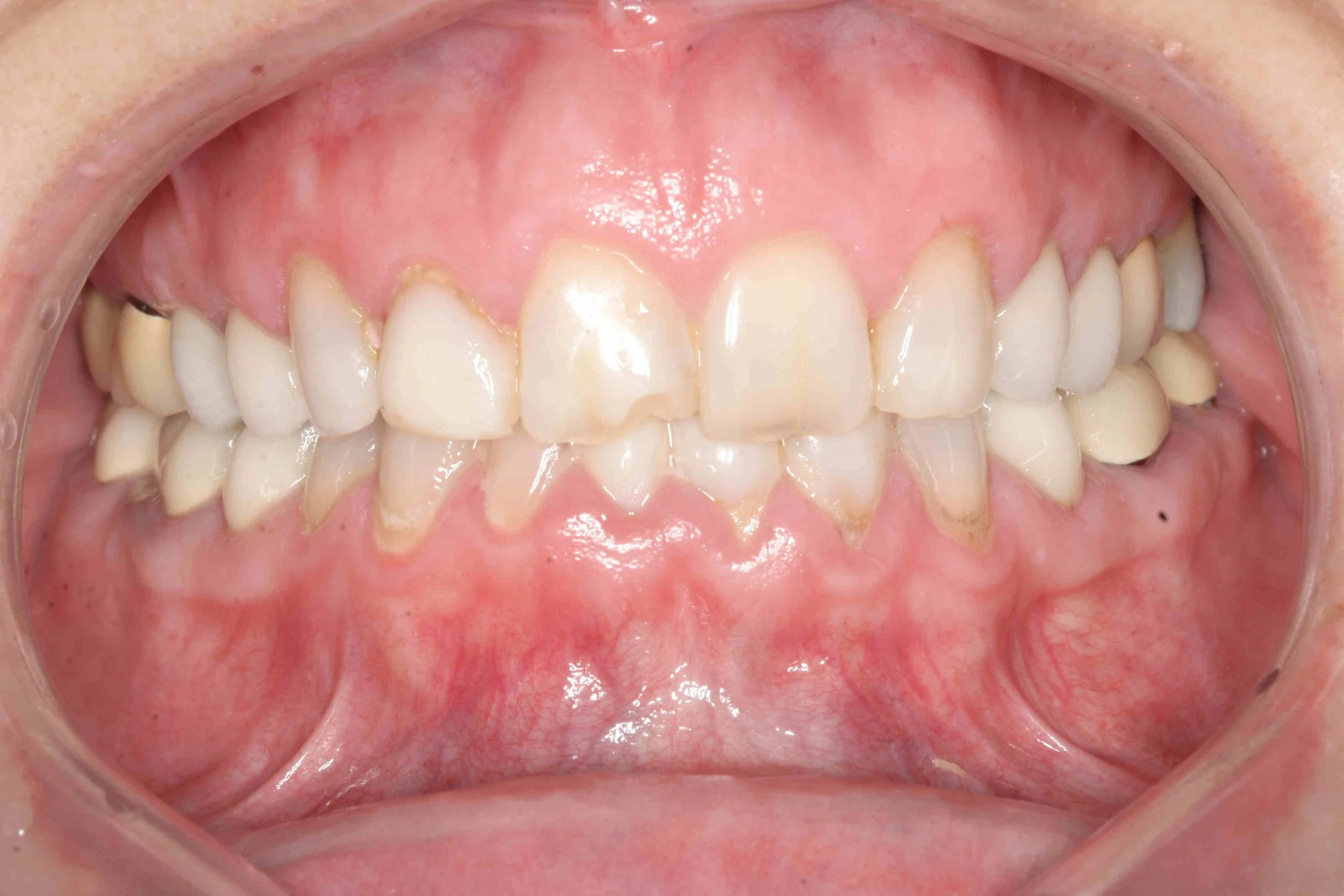 Before: retracted intraoral view showing short-looking upper teeth covered by excess gum tissue.
