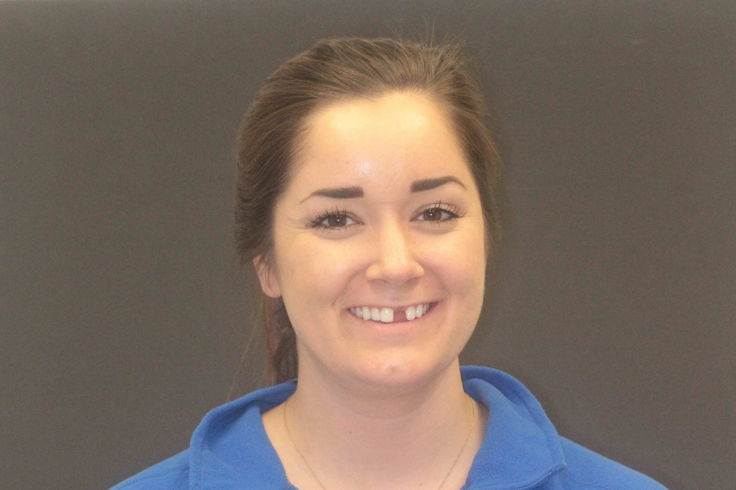 Before: a 25-year-old patient smiling with an upper central incisor missing.