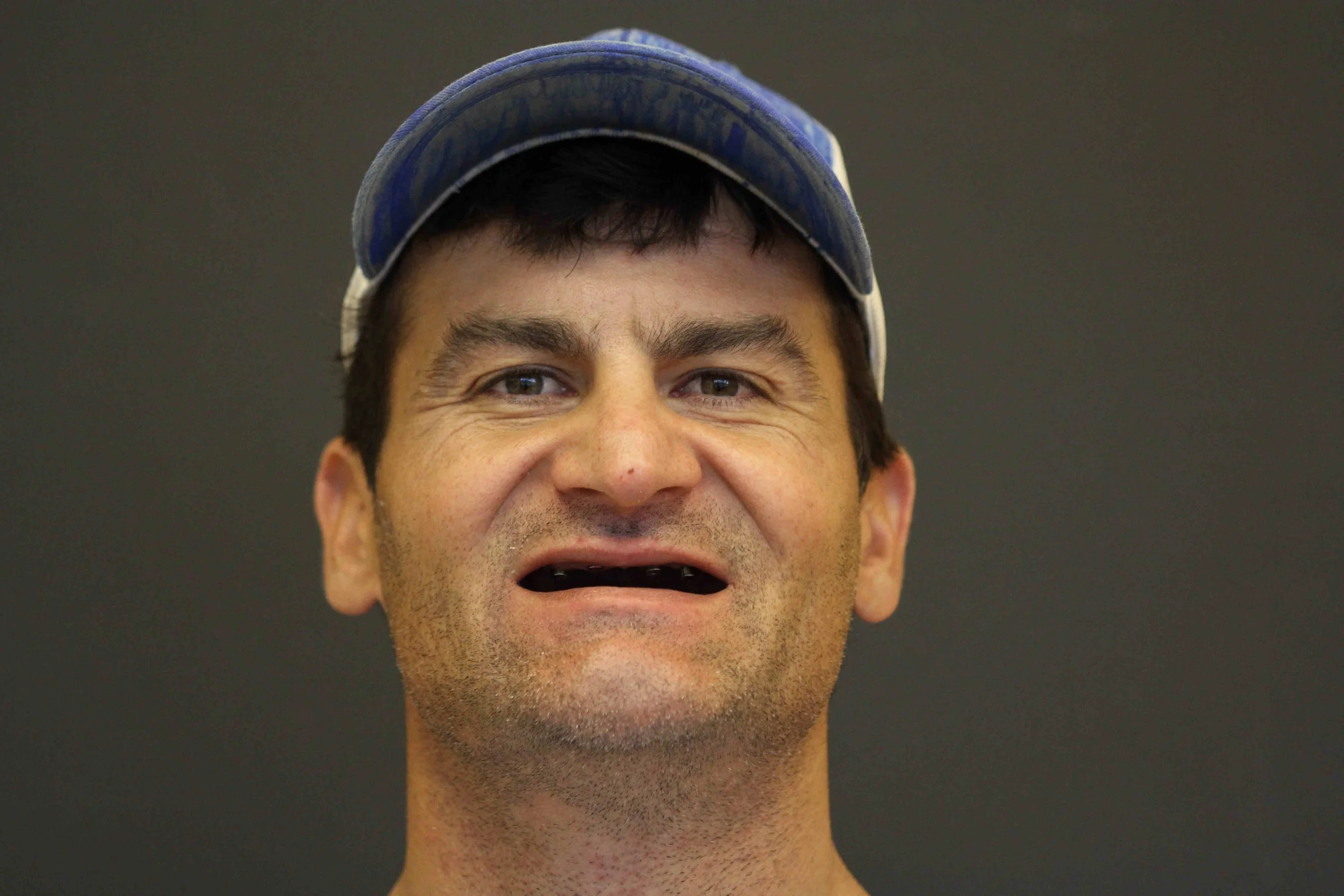 Before: an adult male patient photographed without upper teeth, lips unsupported.