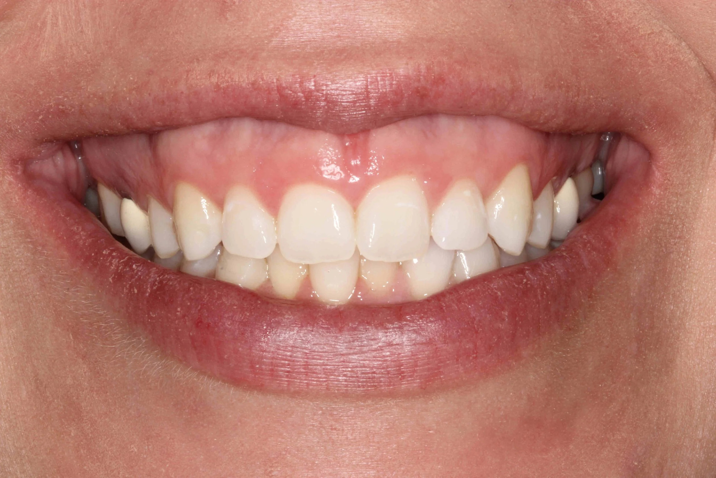 Before: close-up of the patient's smile showing a wide band of gum tissue above the upper teeth.