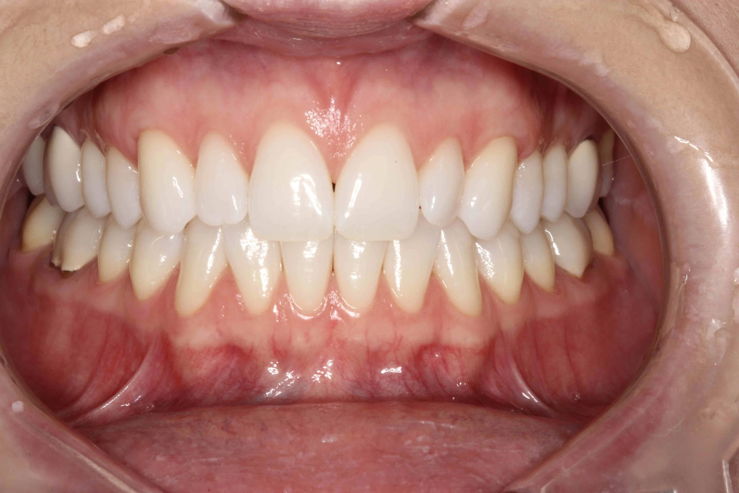 After: recession on the upper canines corrected with connective tissue, six weeks post-operative.
