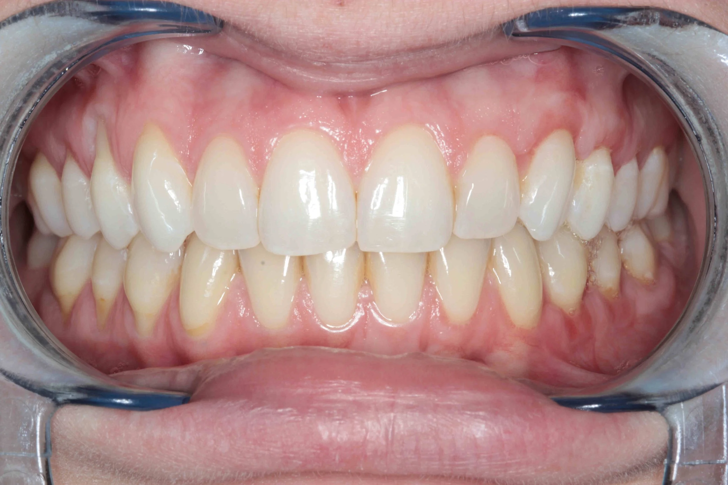 After: connective tissue graft covering previously exposed roots on the left side.