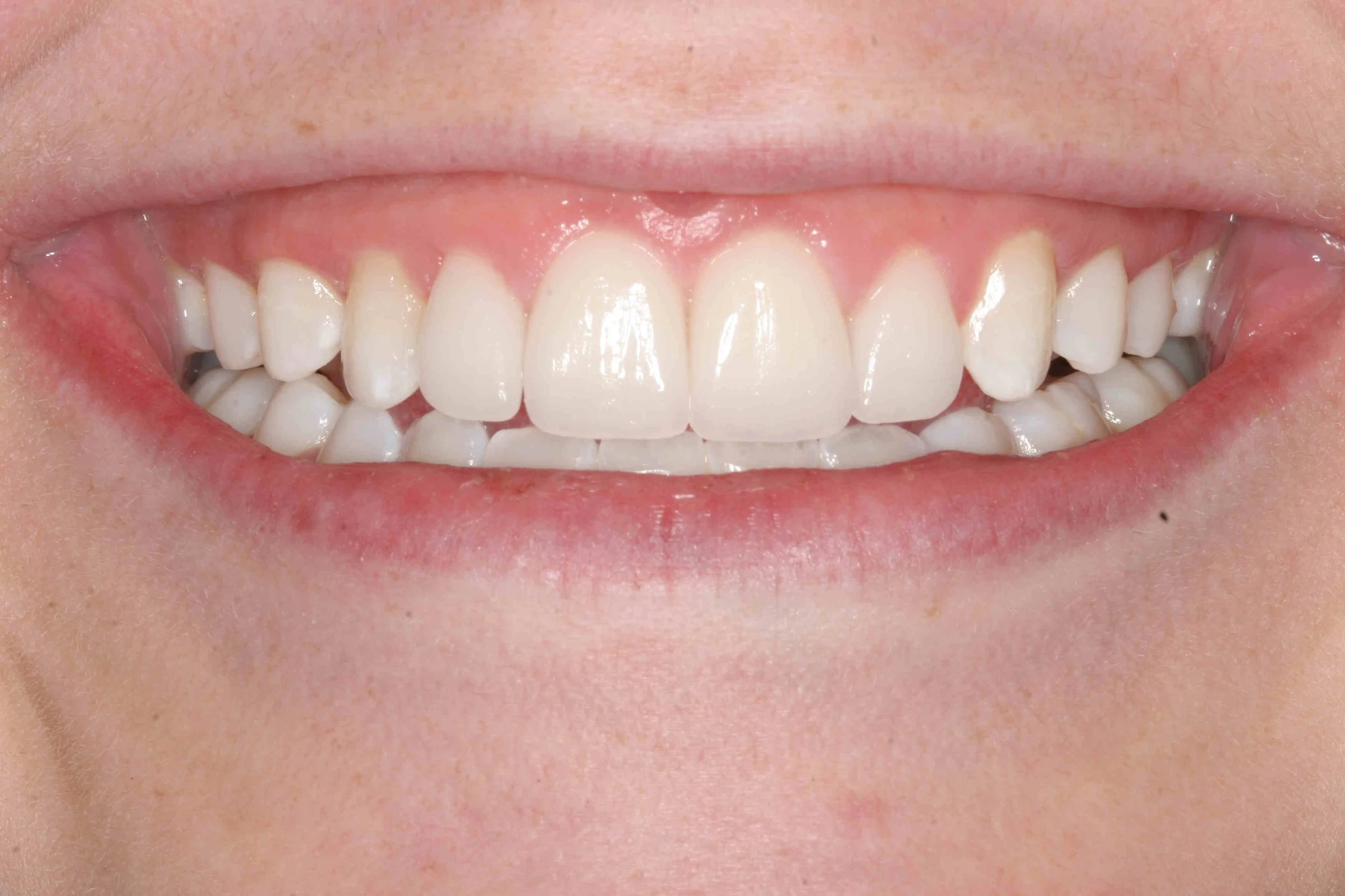 After: crown lengthening revealing more tooth length and less gum tissue when smiling.