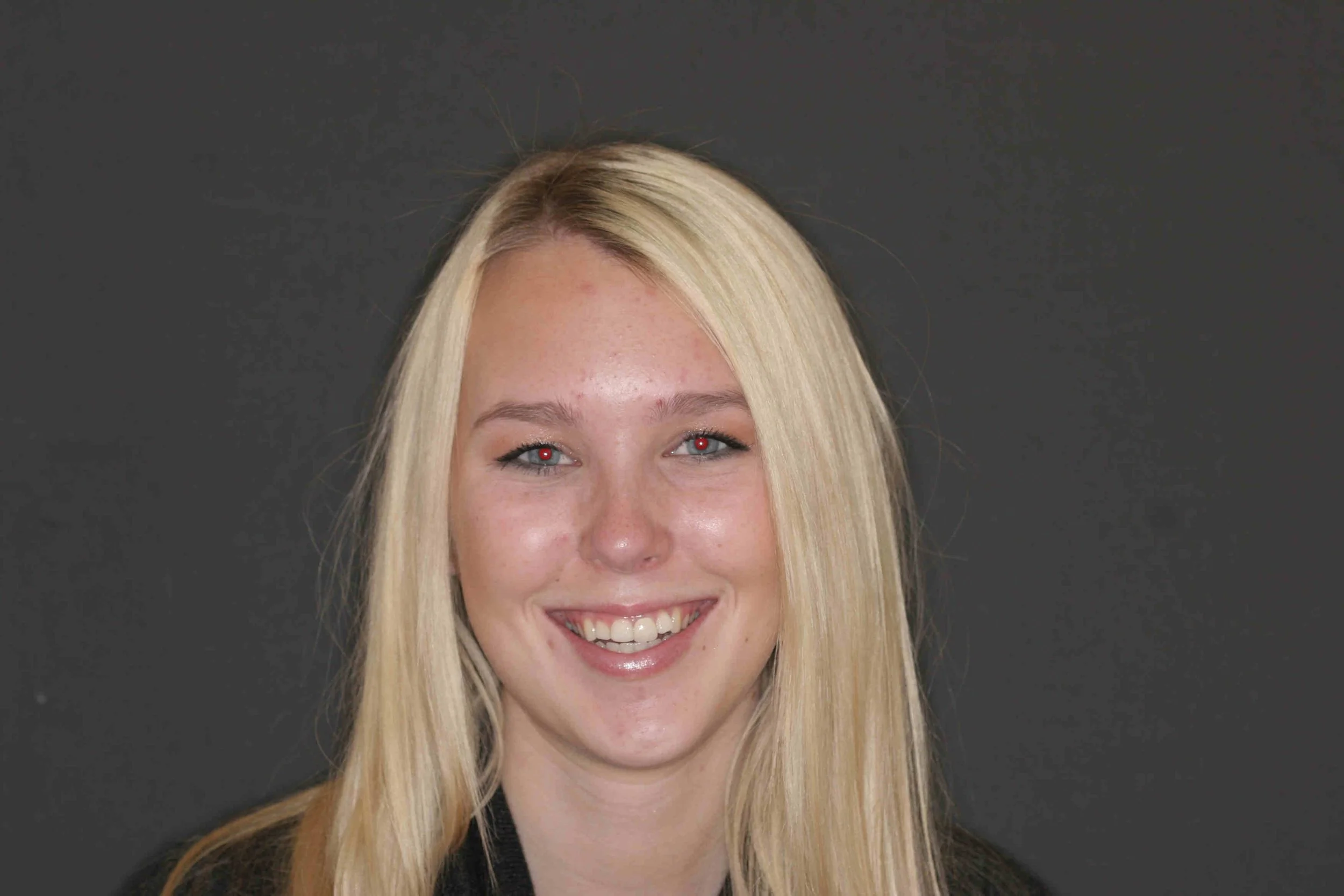 Before: portrait of the same patient smiling prior to crown lengthening and veneers.