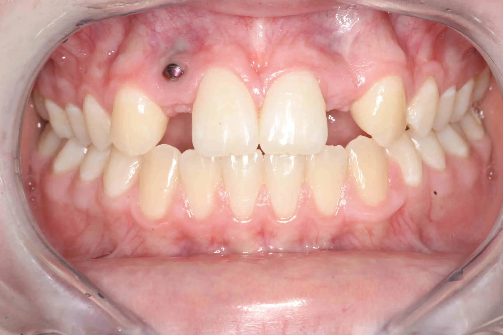 Before: retracted intraoral view showing an implant protruding through the gum tissue at the upper left.