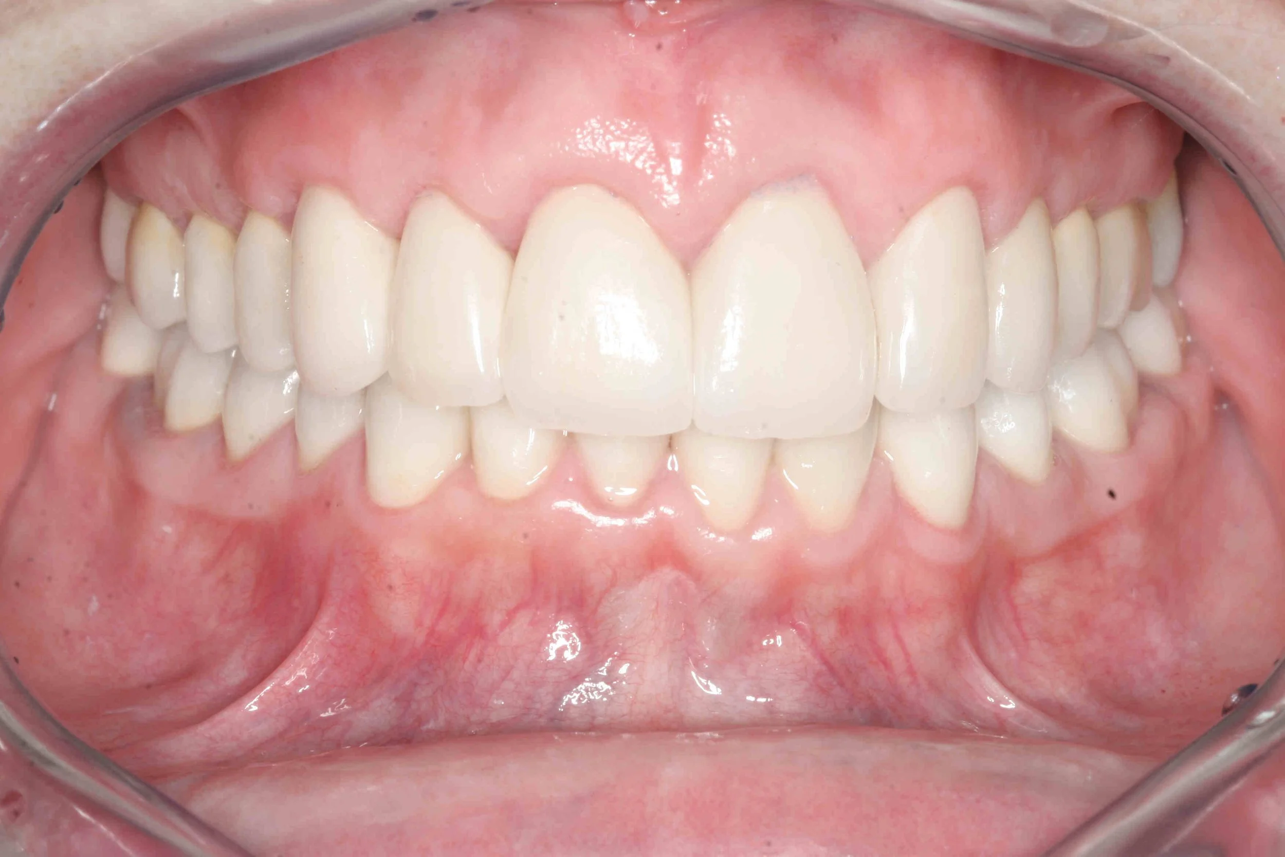 After: crown lengthening has reduced the amount of gum tissue shown when smiling.