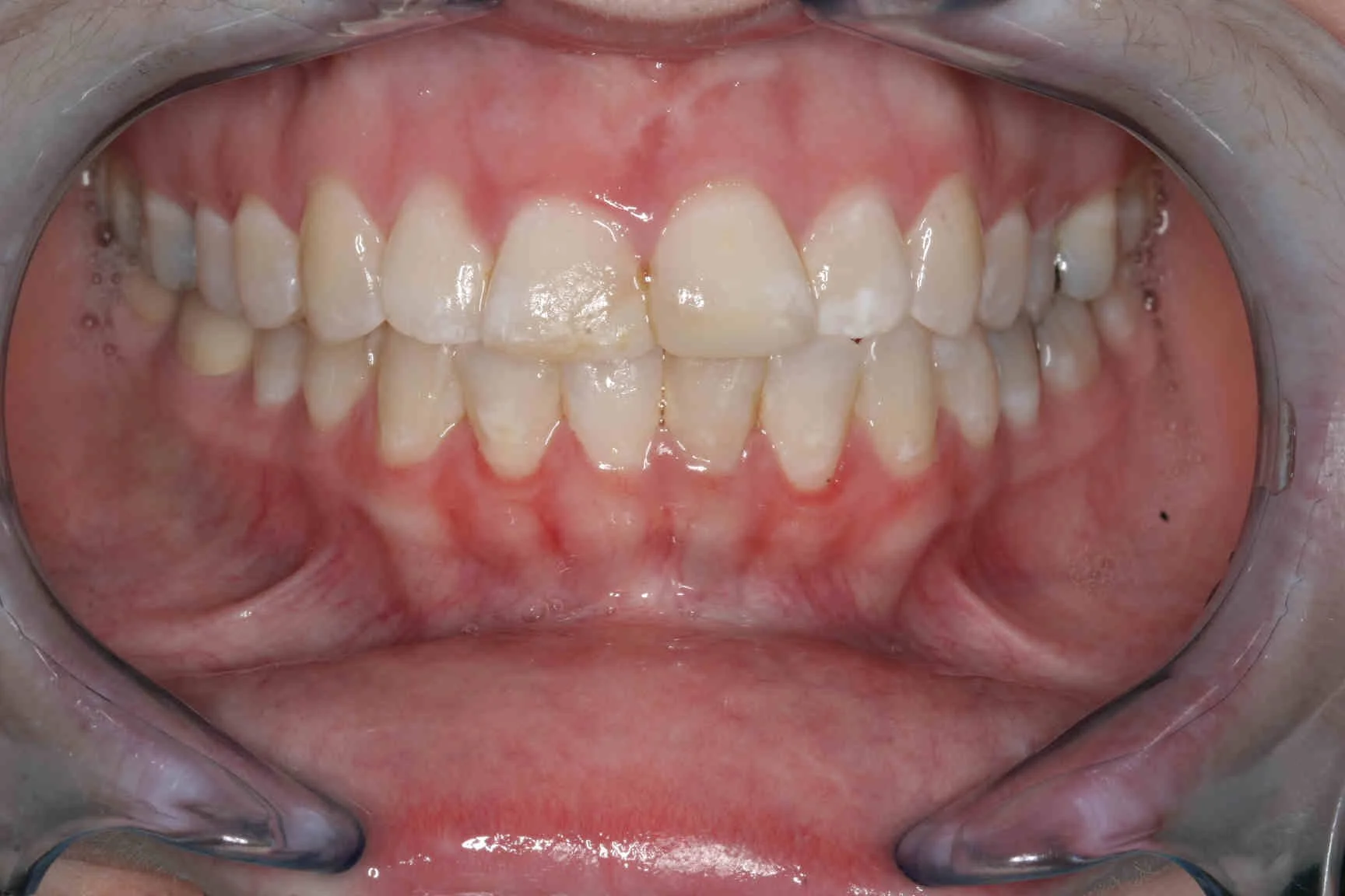 Before: retracted intraoral view showing an uneven gum line across the upper front teeth.