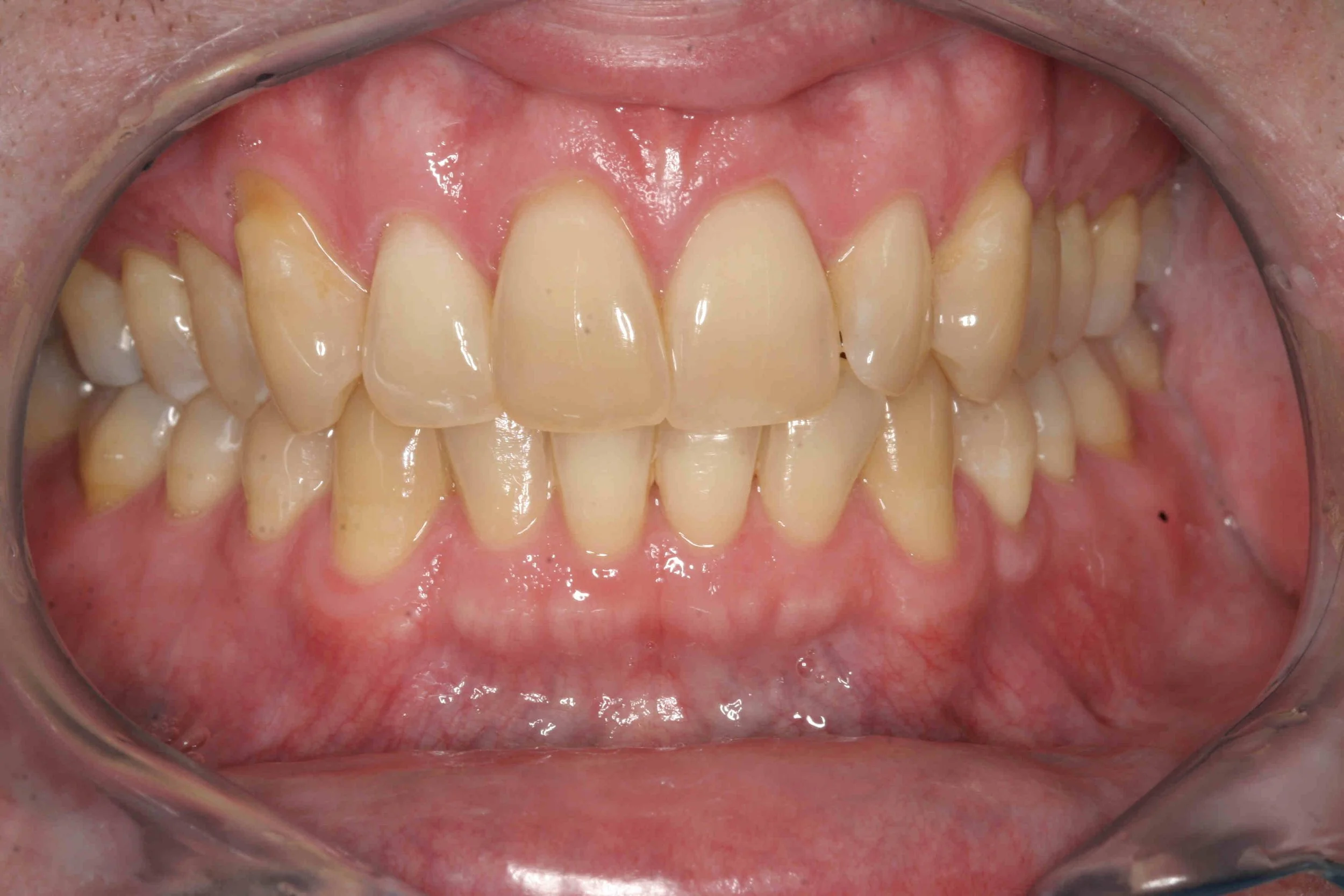 Before: retracted intraoral view showing exposed, sensitive root surfaces on the upper canines.