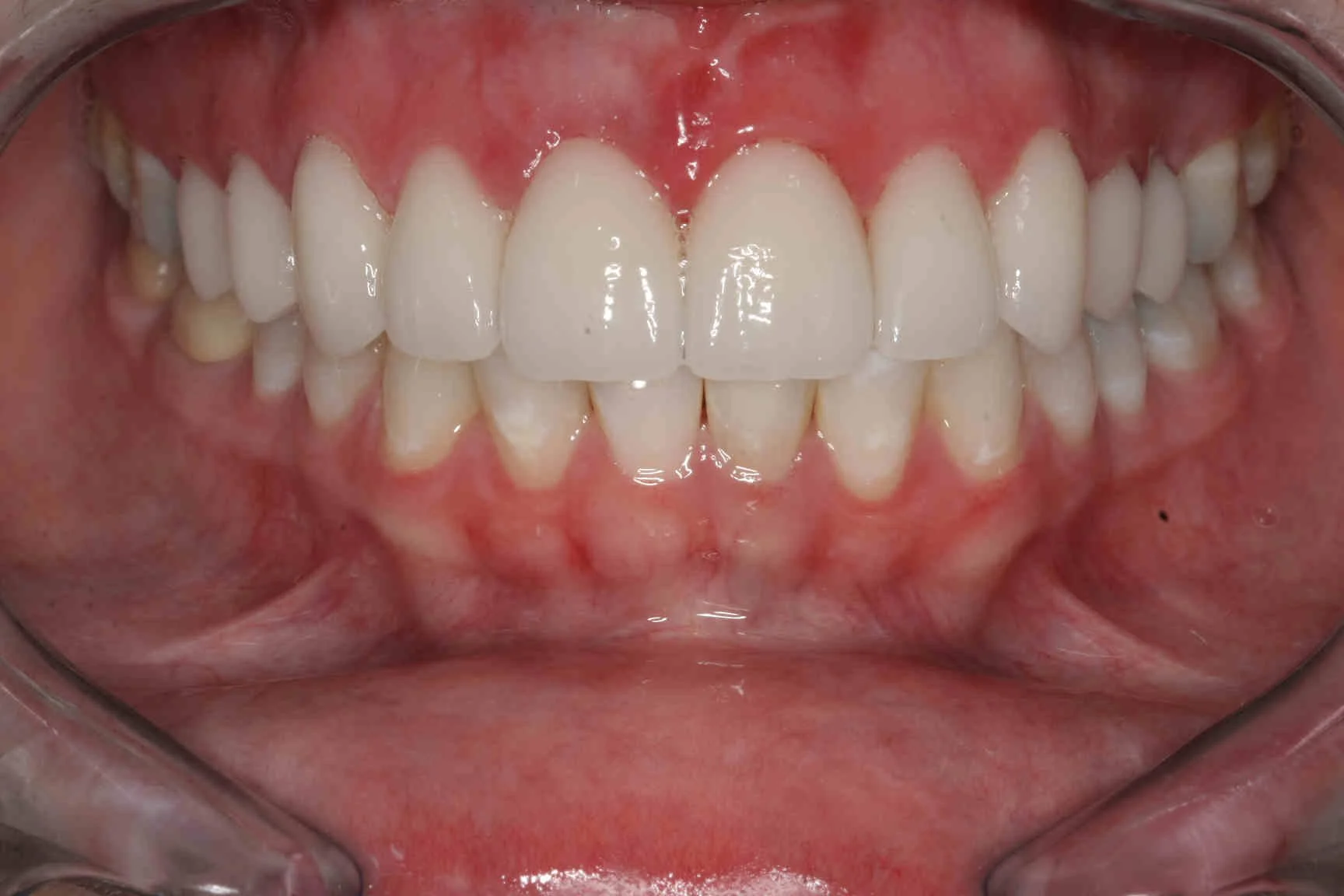 After: gum contour evened out following crown lengthening.