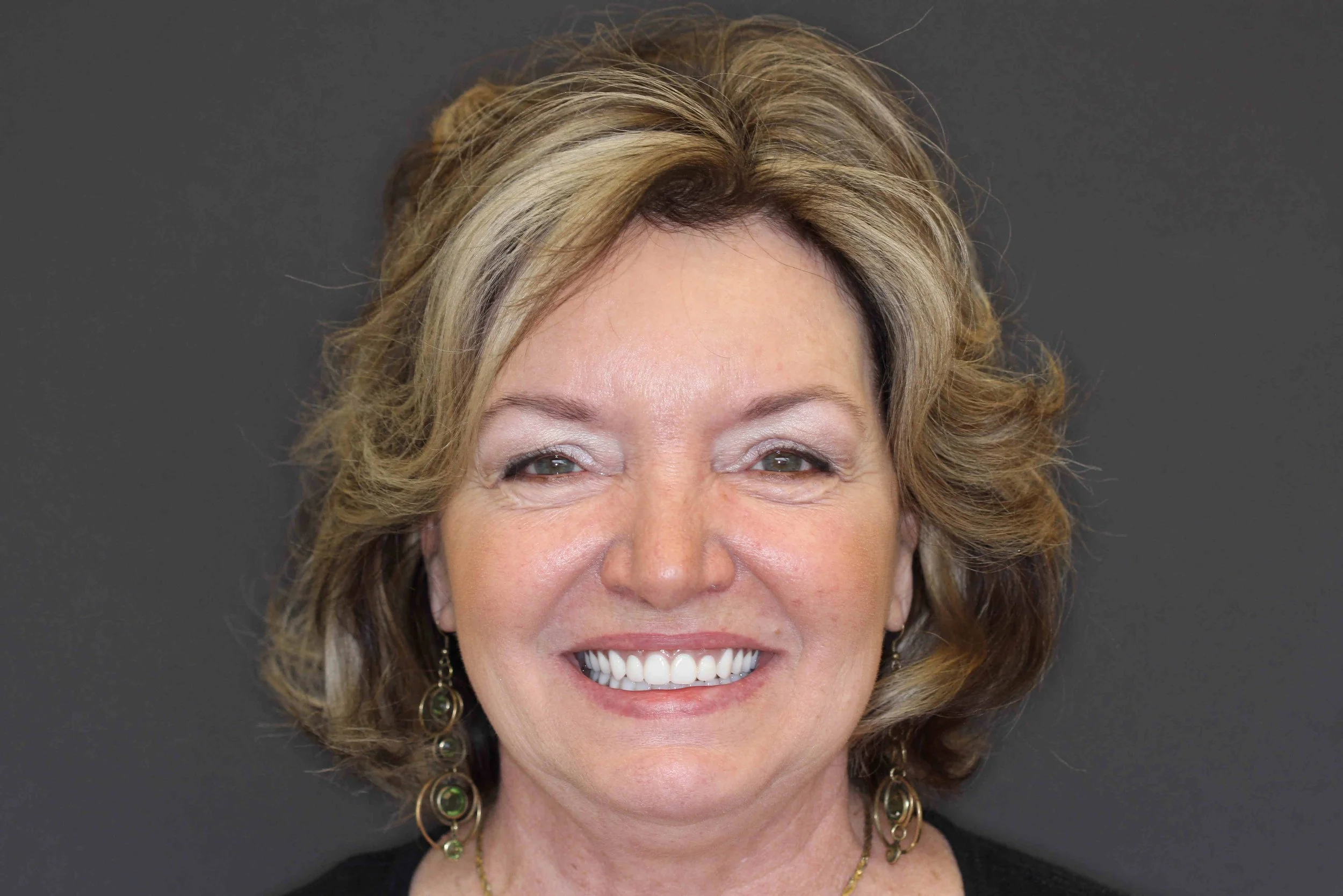 After: patient smiling openly with an implant-supported upper prosthesis.