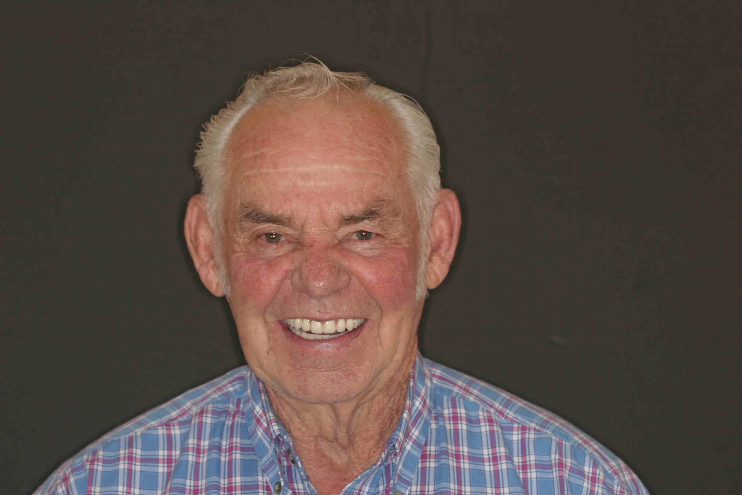 After: the same patient smiling broadly, his missing upper teeth replaced with implant-supported teeth in place of the removable partial denture.