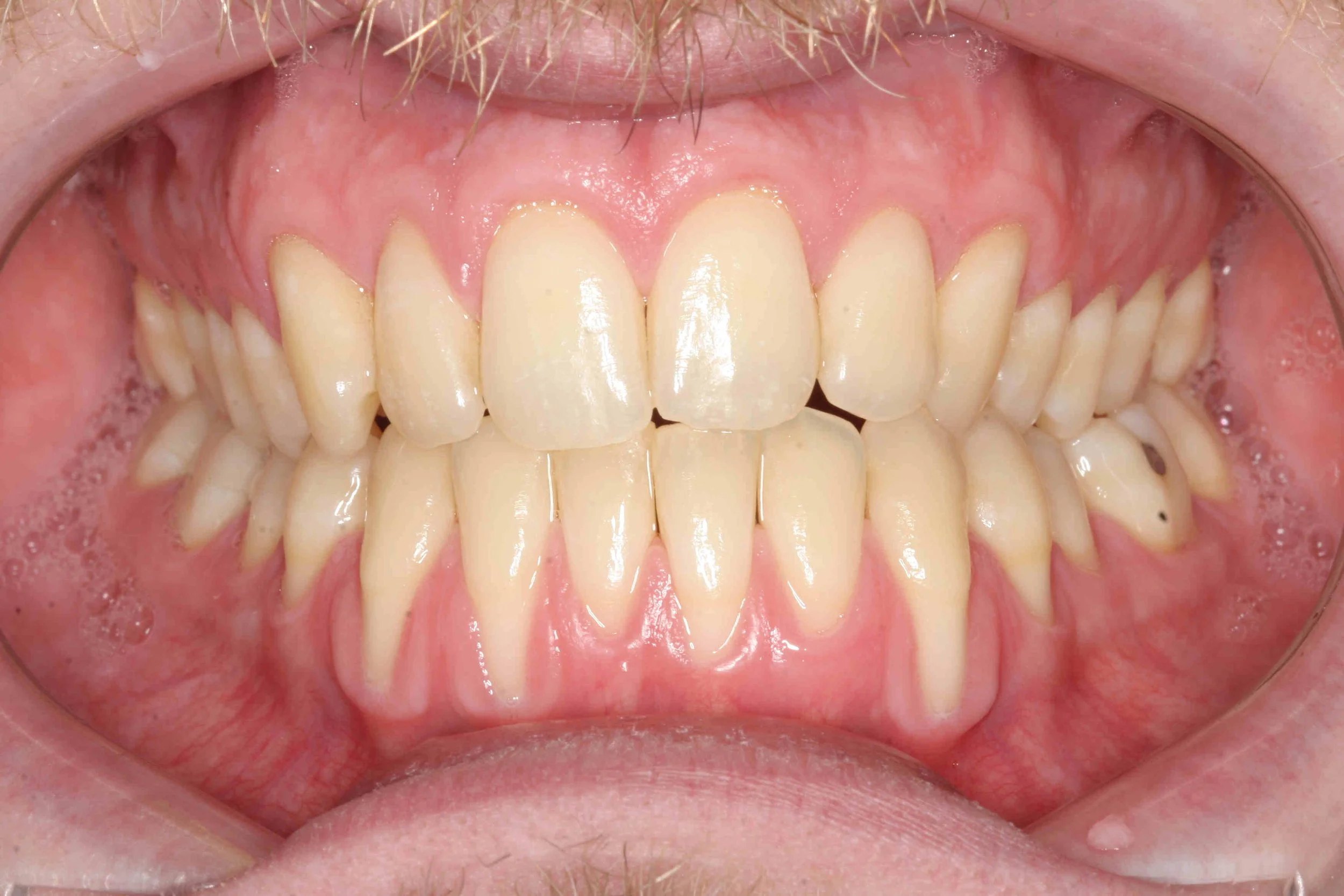 Before: retracted intraoral view showing recession from aggressive toothbrushing.