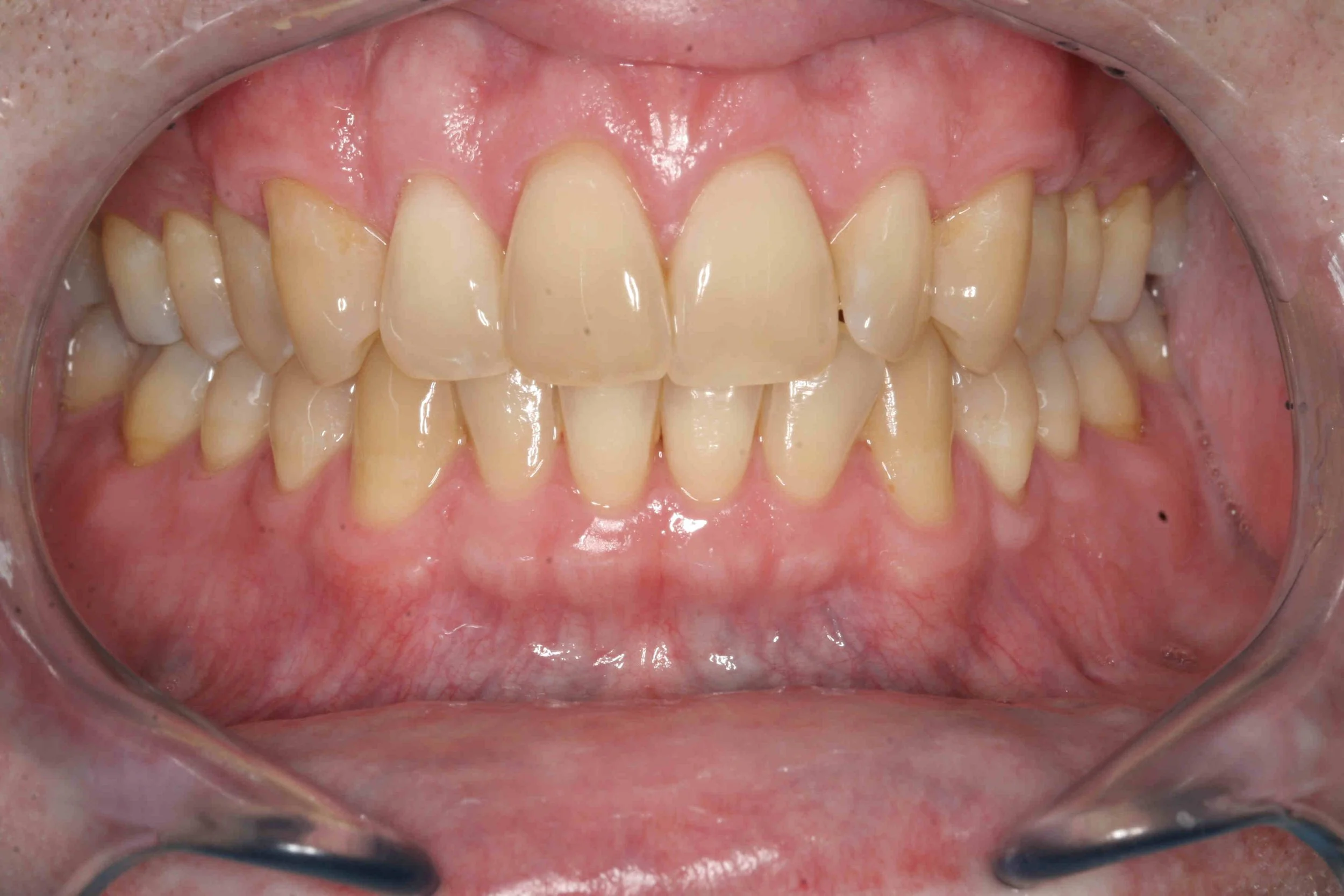 After: exposed root surfaces covered, two months following connective tissue grafting.