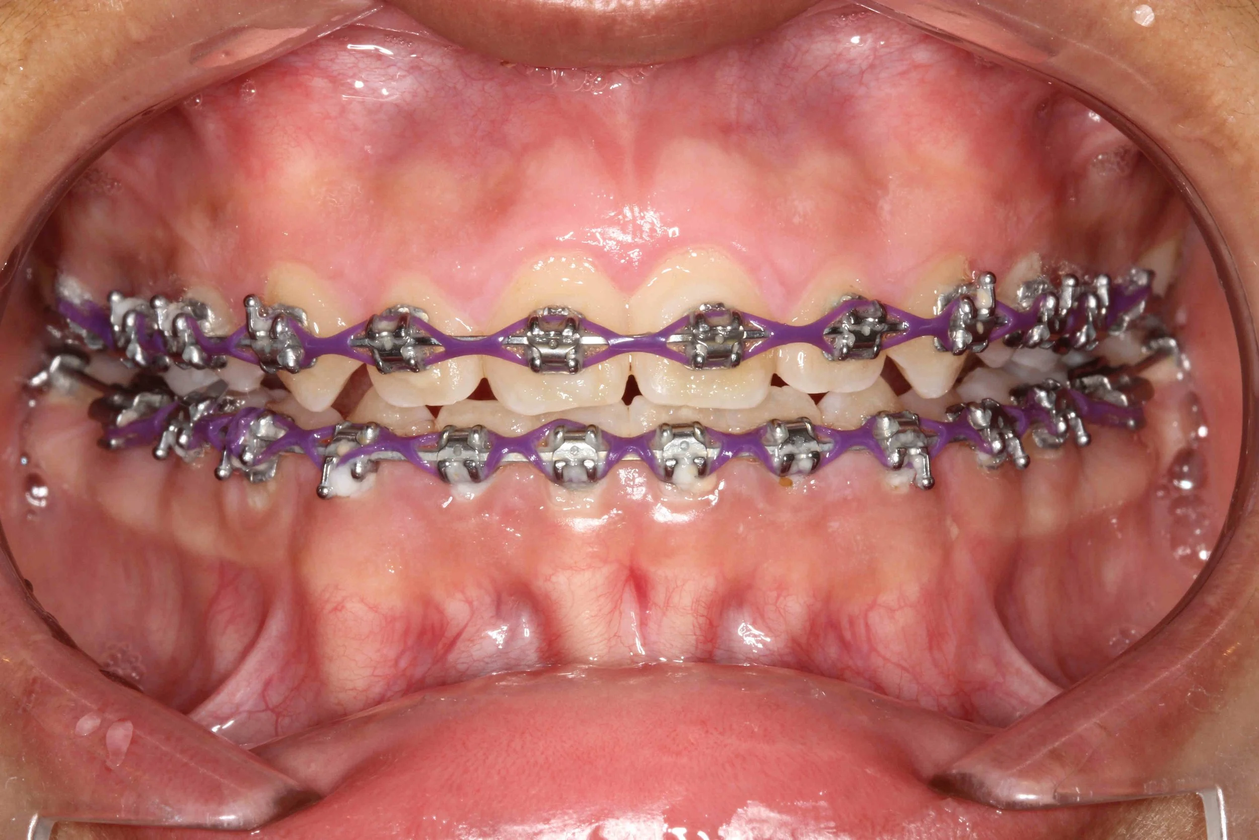 After: excess gum tissue removed so orthodontic treatment and brushing can progress.