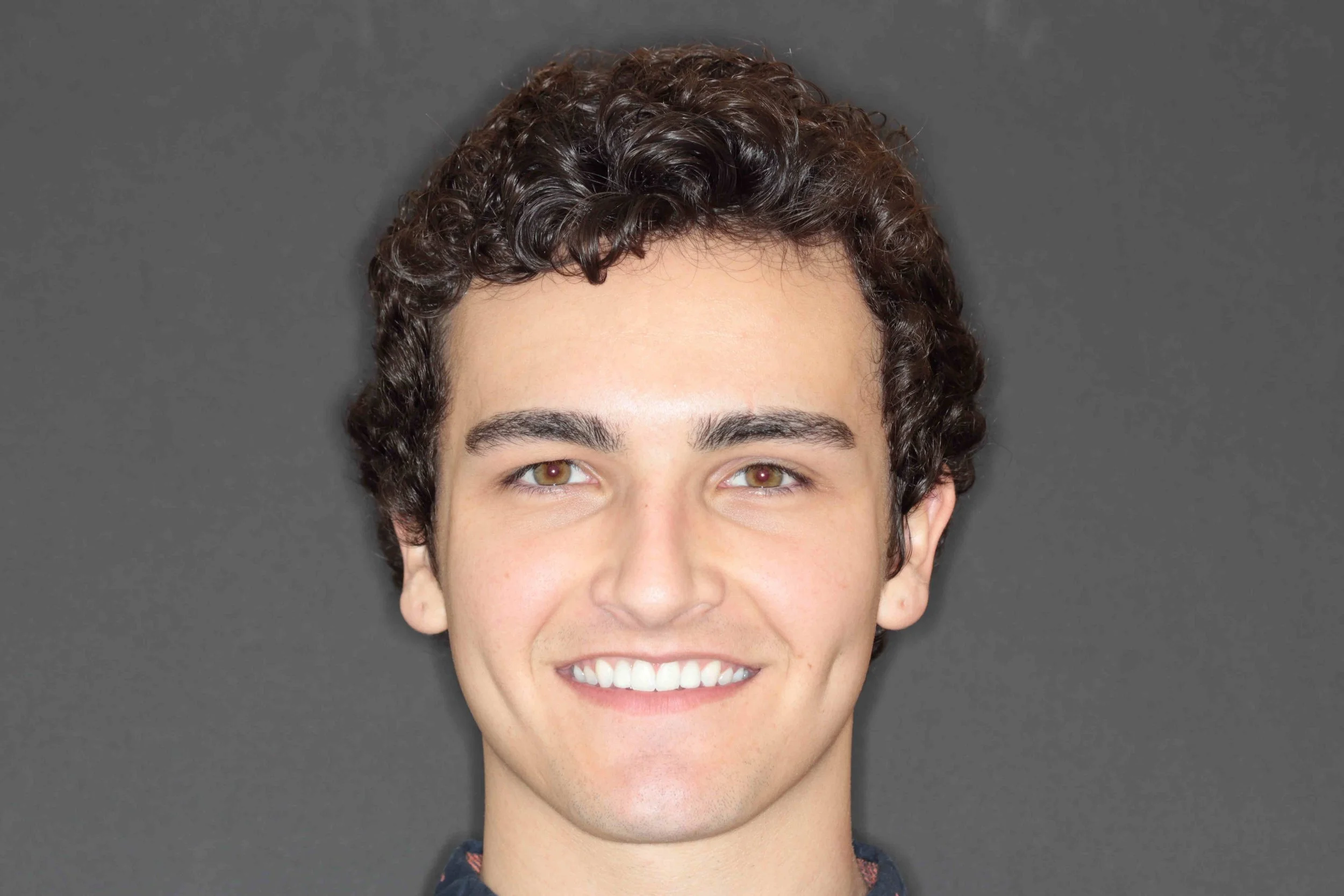 After: teenage patient smiling with implant crowns replacing both lateral incisors.